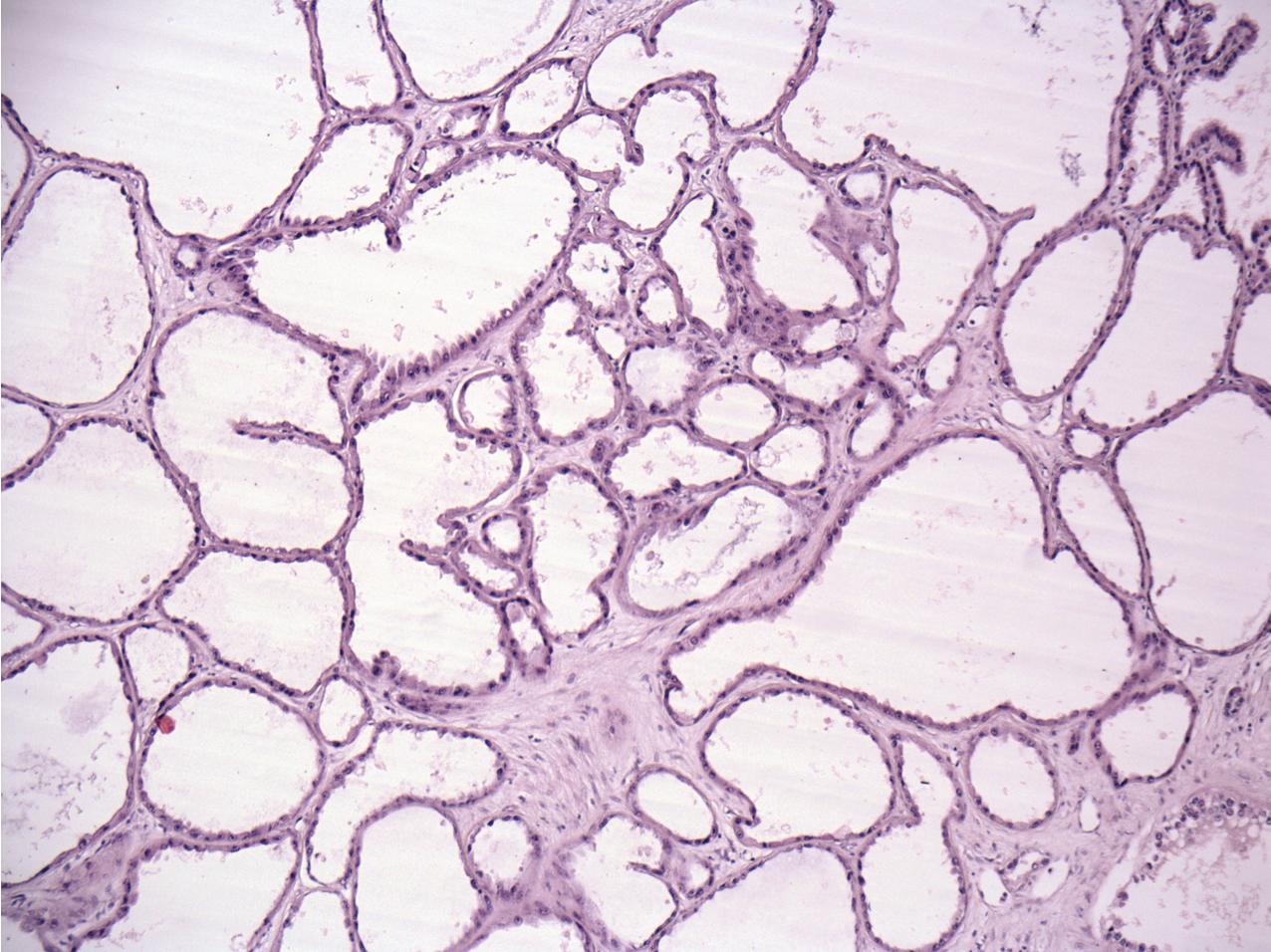 FIG. 10.18, Tubulocystic renal cell carcinoma. The tumor consists of dilated tubular structures with delicate septae lined with eosinophilic cells with a so-called “hobnail” appearance (hematoxylin and eosin, ×400).