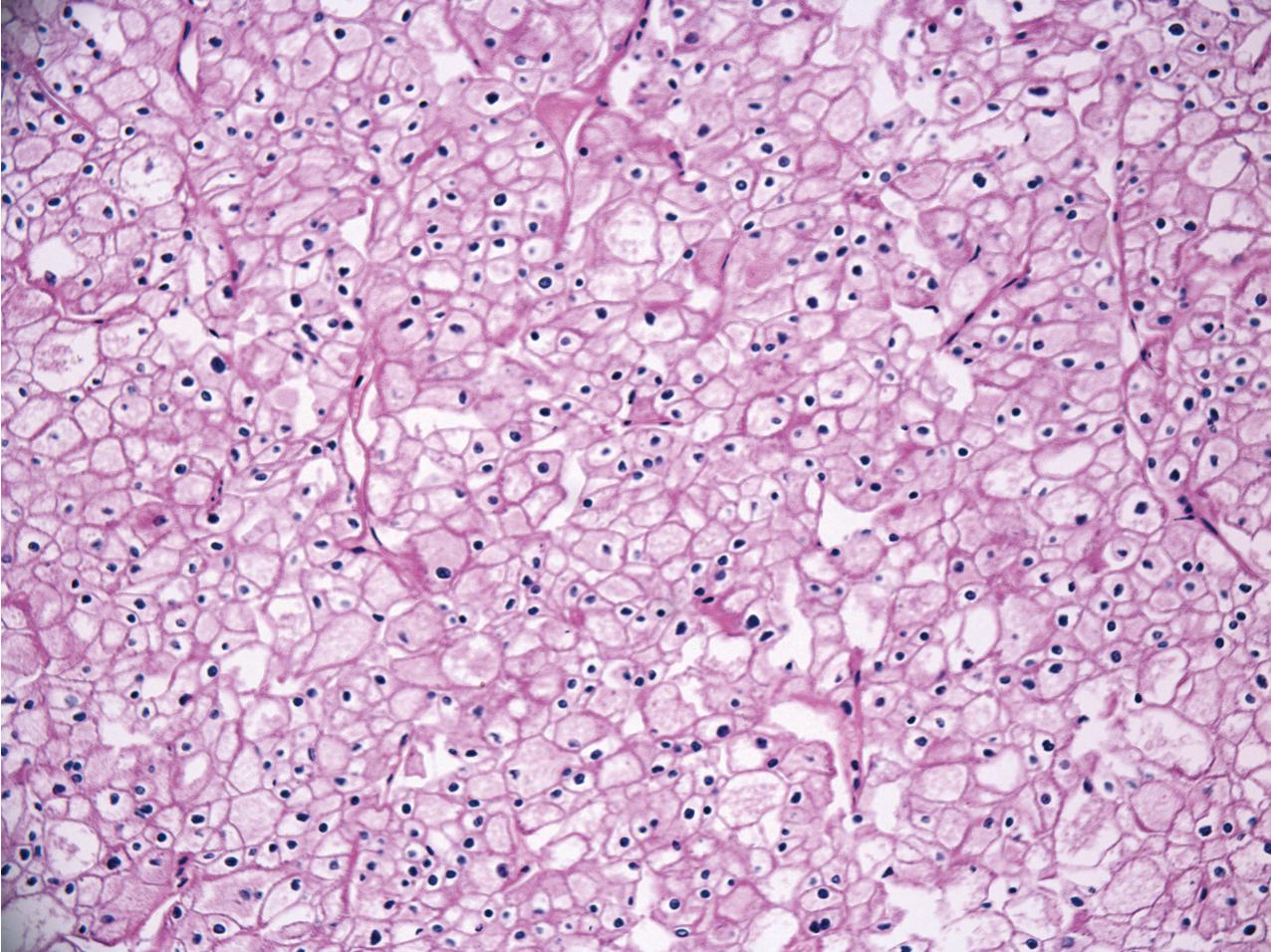 FIG. 10.19, Chromophobe renal cell carcinoma. The tumor consists of sheets of cells with a thin fibrovascular stroma. The cytoplasm is prominent and has a pale staining pattern (hematoxylin and eosin, ×100).