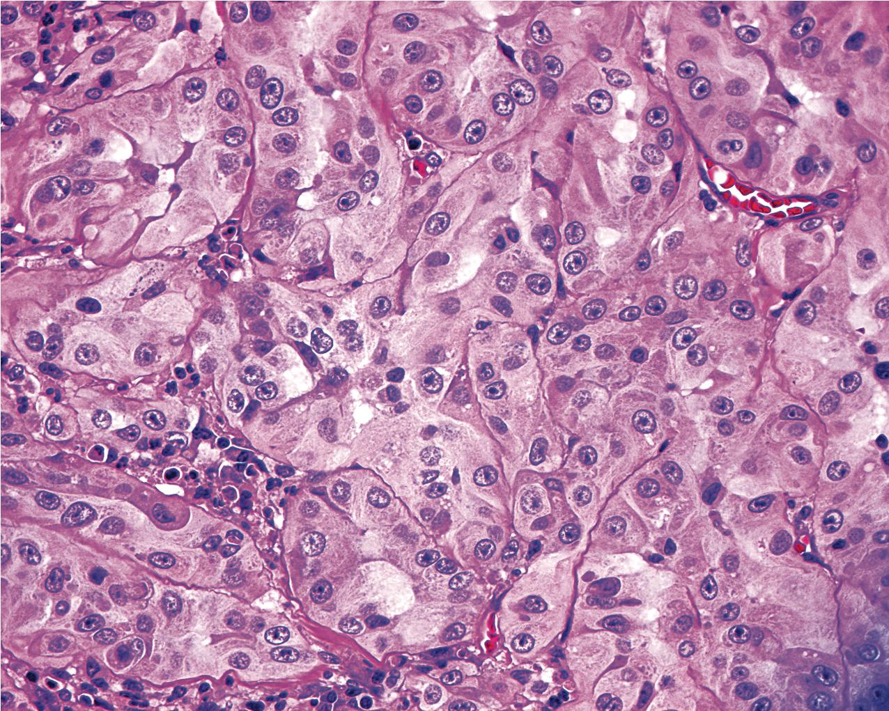 FIG. 10.20, Chromophobe renal cell carcinoma. The cytoplasm of the cells contains large numbers of minute intracytoplasmic vesicles, giving a pale reticular or flocculent appearance to the cytoplasm (hematoxylin and eosin, ×400).