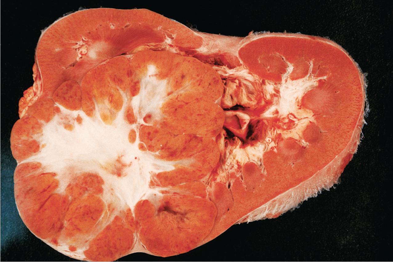 FIG. 10.2, Renal oncocytoma. The brown color is typical of the oncocytoma. The tumor also demonstrates a central fibrous core.