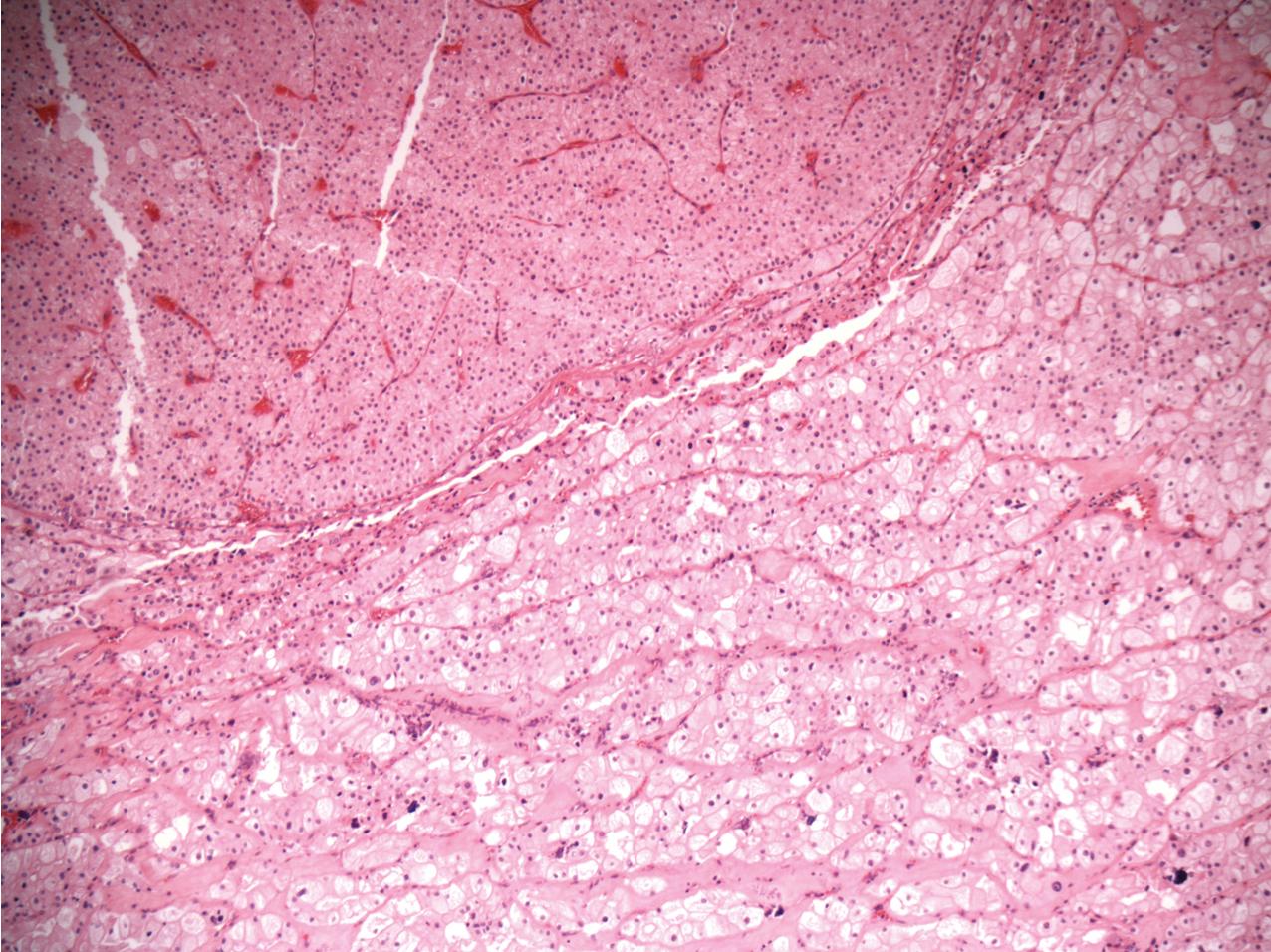 FIG. 10.21, Hybrid oncocytic chromophobe renal cell carcinoma. There is an admixture of oncocytic tumor cells with more typical chromophobe carcinoma cells. This tumor is often associated with 17p11 Birt-Hogg-Dubé syndrome (hematoxylin and eosin, ×200).