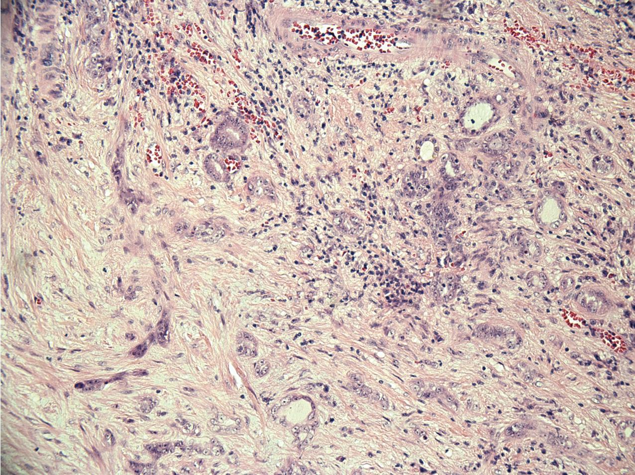 FIG. 10.22, Carcinoma of the collecting ducts of Bellini. The tumor consists of complex, ductlike tubular cells interspersed with a desmoplastic stroma (hematoxylin and eosin, ×400).