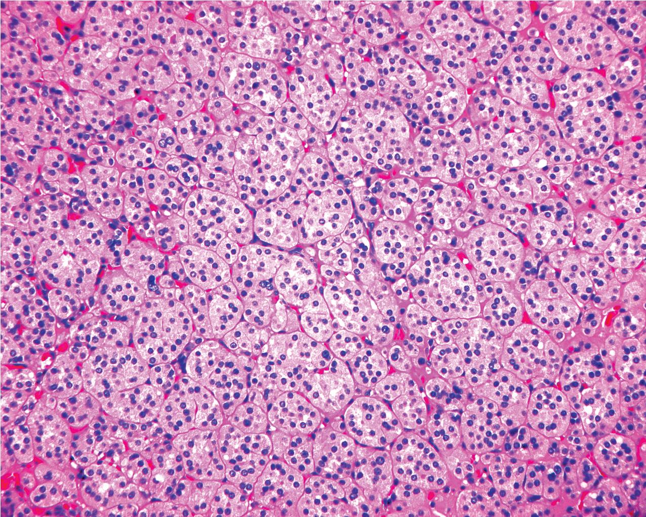 FIG. 10.3, Renal oncocytoma. The cells of the oncocytoma are arranged in diffuse sheets or islands of tumor cells with a background of edematous connective tissue (hematoxylin and eosin, ×100).