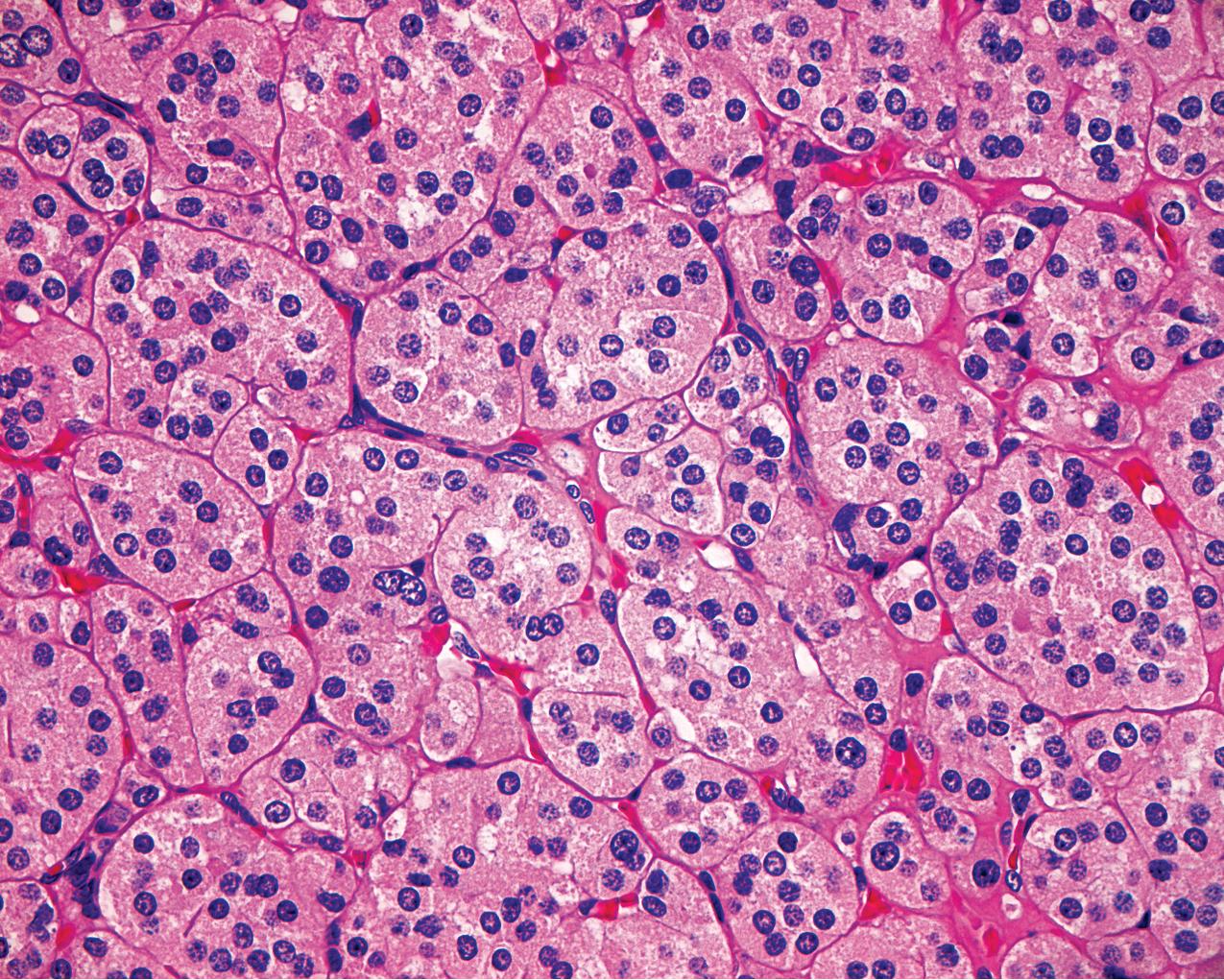 FIG. 10.4, Renal oncocytoma. There is a relatively even pattern of cells with uniform nuclei and a granular eosinophilic use of the cytoplasm (hematoxylin and eosin, ×400).