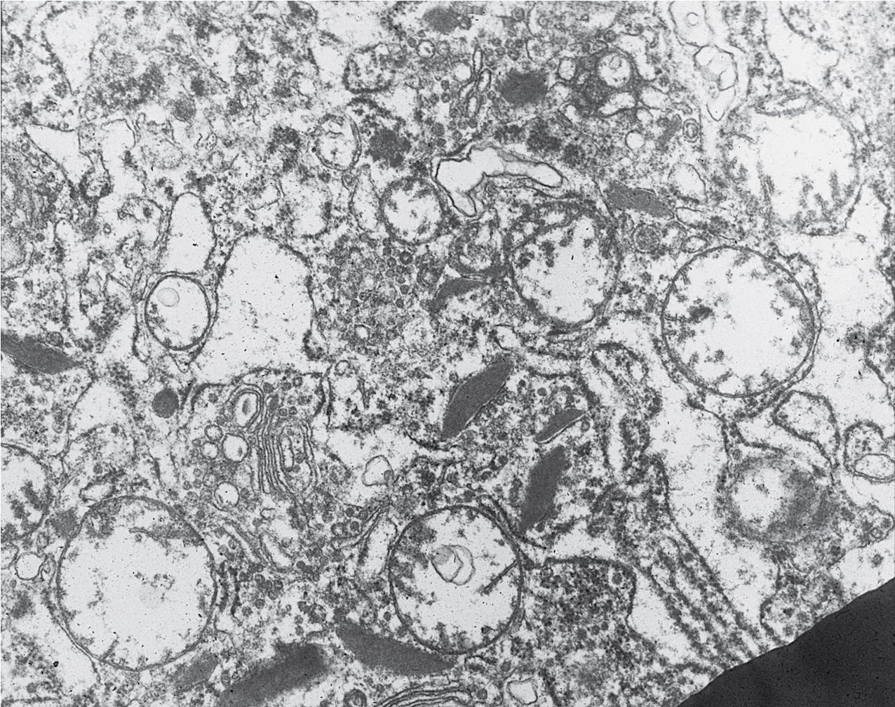 FIG. 10.5, Renal oncocytoma. There are abundant mitochondria, which give a granular appearance by light microscopy (transmission electron microscopy, ×8000).