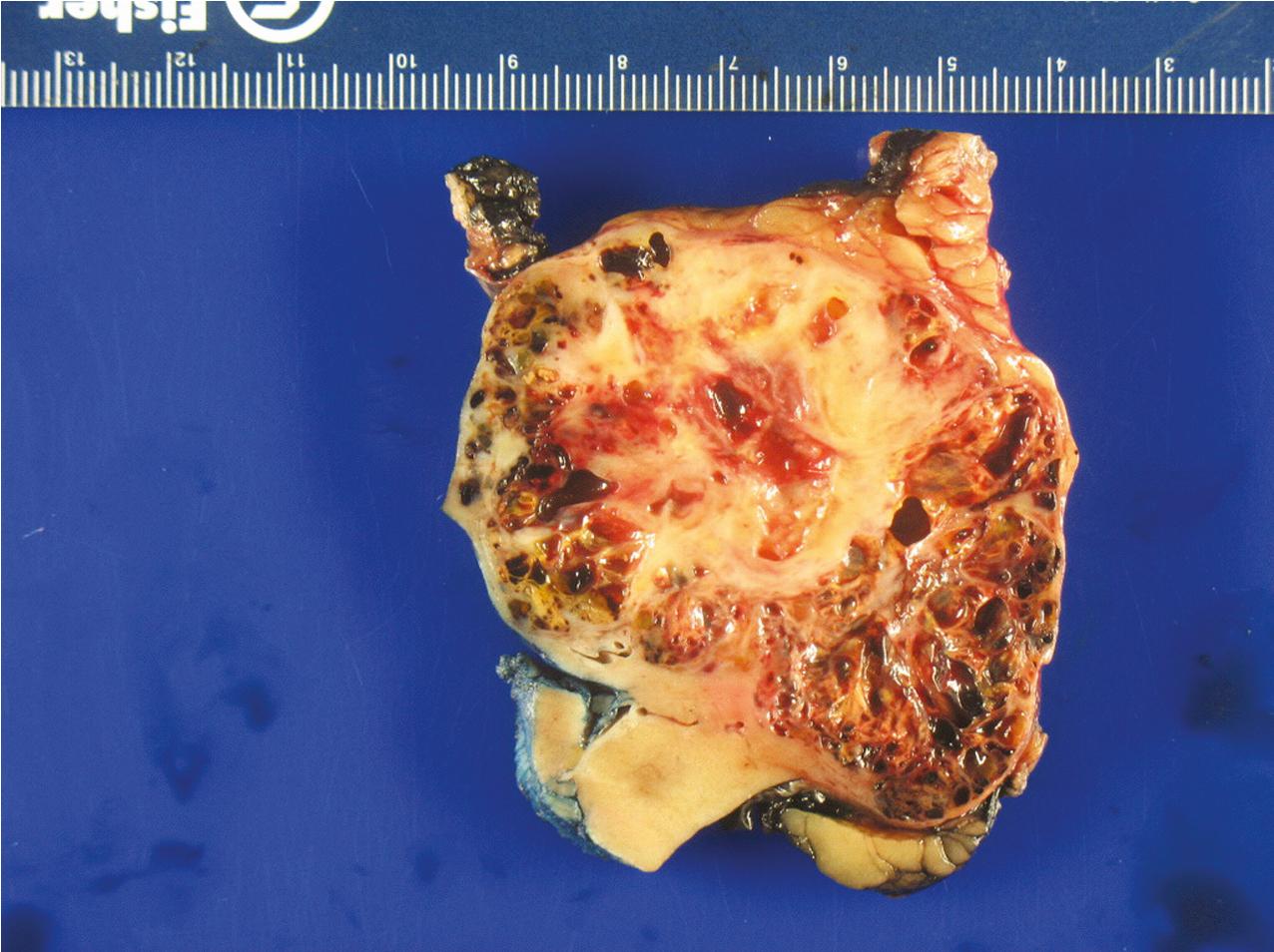 FIG. 10.6, Renal cell carcinoma. There is a lobulated yellow-orange mass with foci of hemorrhage typical of clear cell renal cell carcinoma.