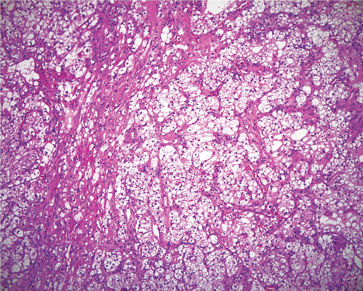 FIG. 10.7, Renal clear cell carcinoma. There is a prominent, delicate vasculature throughout the tumor with strands of fibrosis. The cells are clear with dark central nuclei (hematoxylin and eosin, ×100).