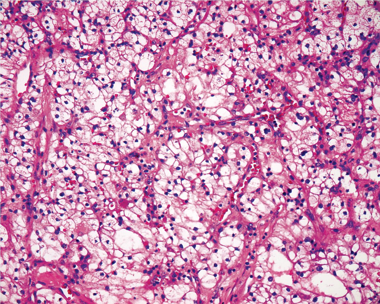 FIG. 10.8, Renal clear cell carcinoma. Higher power demonstrates the fibrovascular core and the nature of the clear cells (hematoxylin and eosin, ×200).