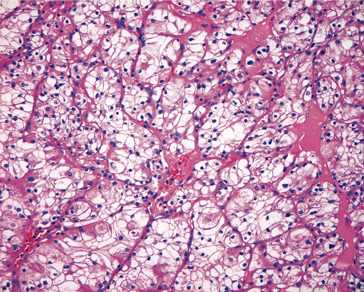 FIG. 10.9, Renal clear cell carcinoma. Delicate fibrovascular stroma surrounds cells with clear cytoplasm and eccentric dark nuclei (hematoxylin and eosin, ×400).