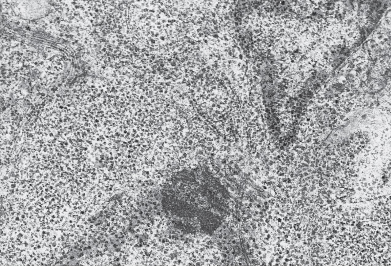 FIG. 10.10, Renal clear cell carcinoma. Electron microscopy reveals the cytoplasm of clear cell tumors containing abundant glycogen (transmission electron microscopy, ×8000).