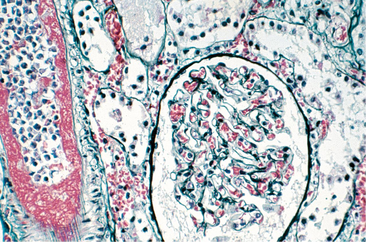 FIG. 8.1, Hyperacute rejection. The artery is occluded by a fibrin thrombus, and there is evidence of congestion in the peritubular capillaries. Focal tubular necrosis is also seen in this silver methenamine Masson stain (×200).