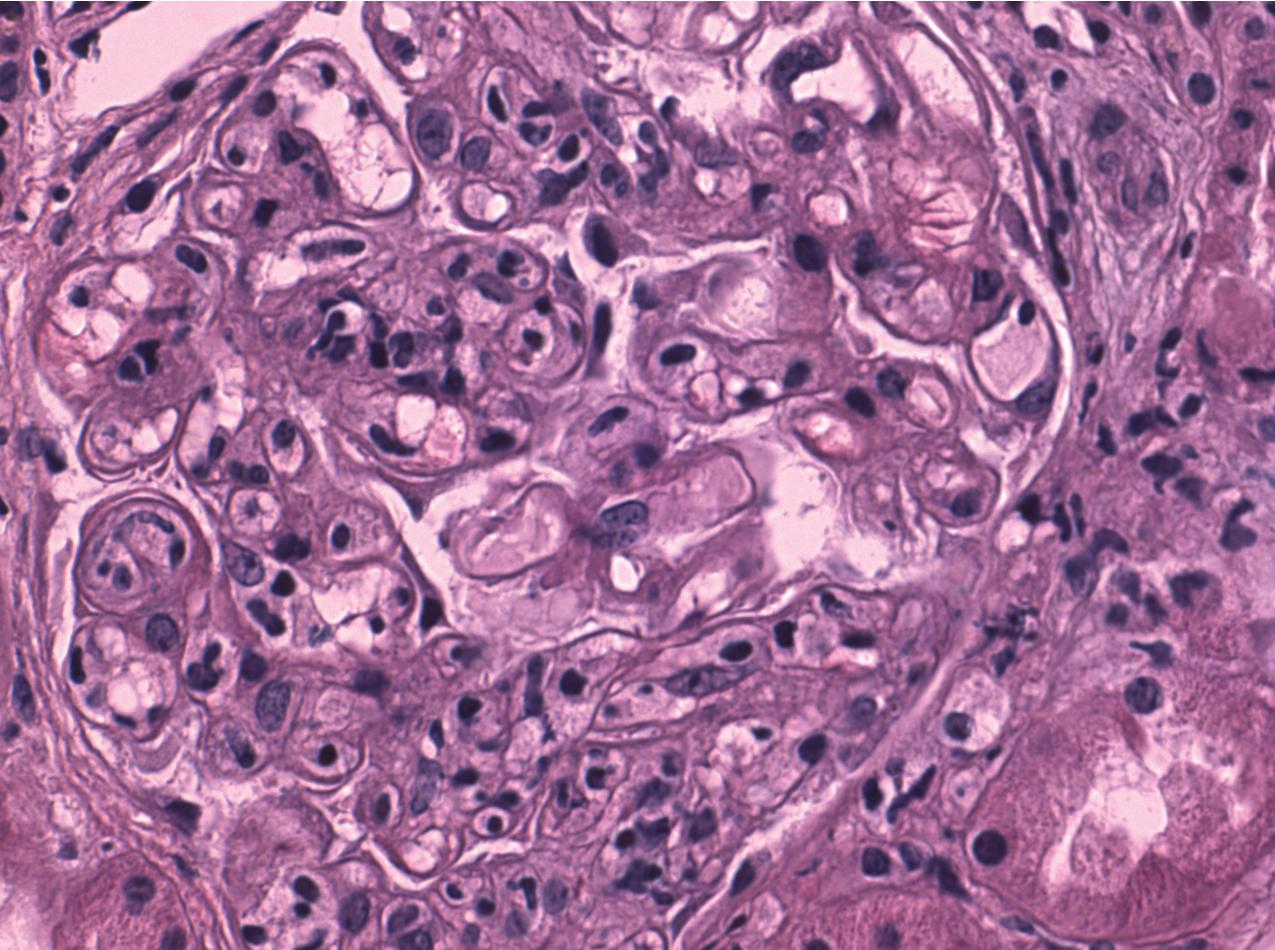 FIG. 8.2, Acute antibody-mediated rejection. Transplant glomerulitis. Glomerulus showing lobular accentuation with an increase in mesangial matrix, mesangial interposition, and irregular thickening and double contours of basement membrane, the latter evidence of early chronic antibody-mediated injury (periodic acid–Schiff, ×400).