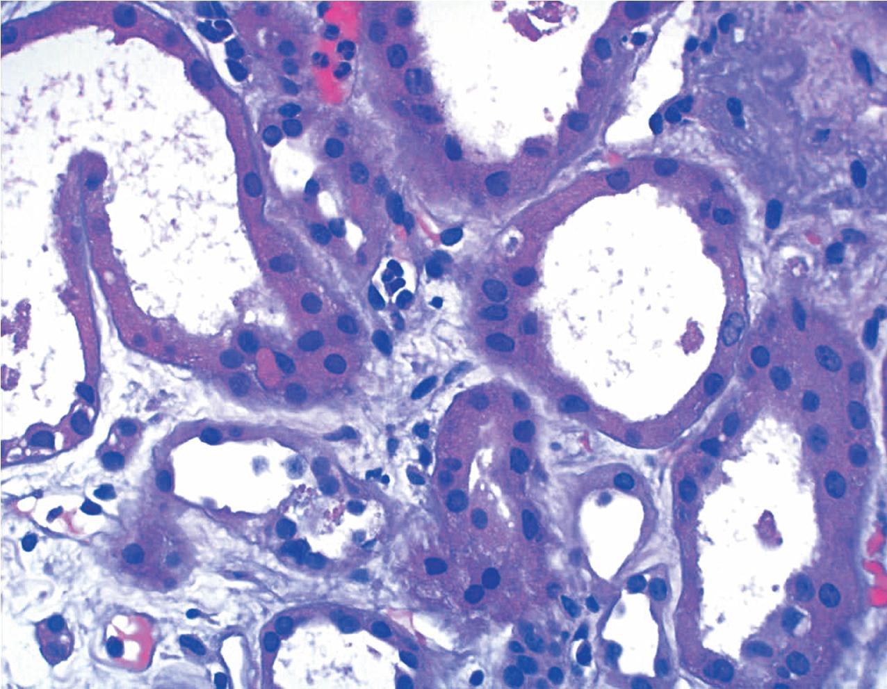 FIG. 8.3, Acute antibody-mediated rejection. Inflammatory cells are present in the peritubular capillaries associated with interstitial edema. Tubulitis and an interstitial infiltrate are not present. These findings are typical of acute antibody-mediated rejection (hematoxylin and eosin, ×400).