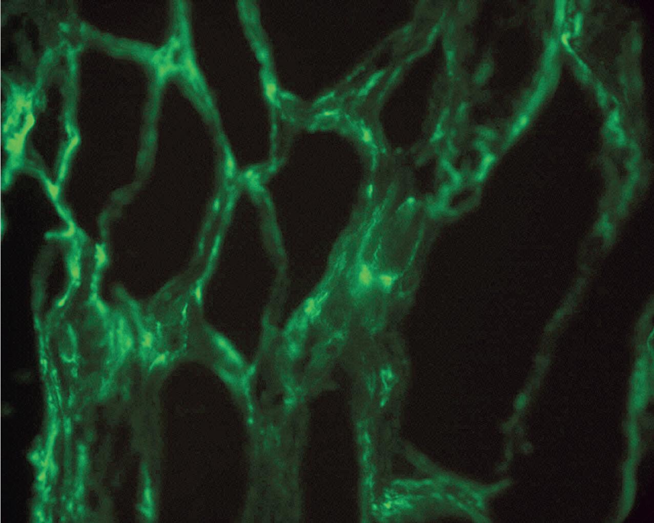 FIG. 8.4, Acute antibody-mediated rejection. Immunopathologic evidence of antibody-mediated rejection is confirmed by the presence of staining for C4d in peritubular capillaries, shown here by indirect immunofluorescence (anti-C4d immunofluorescence, ×400).