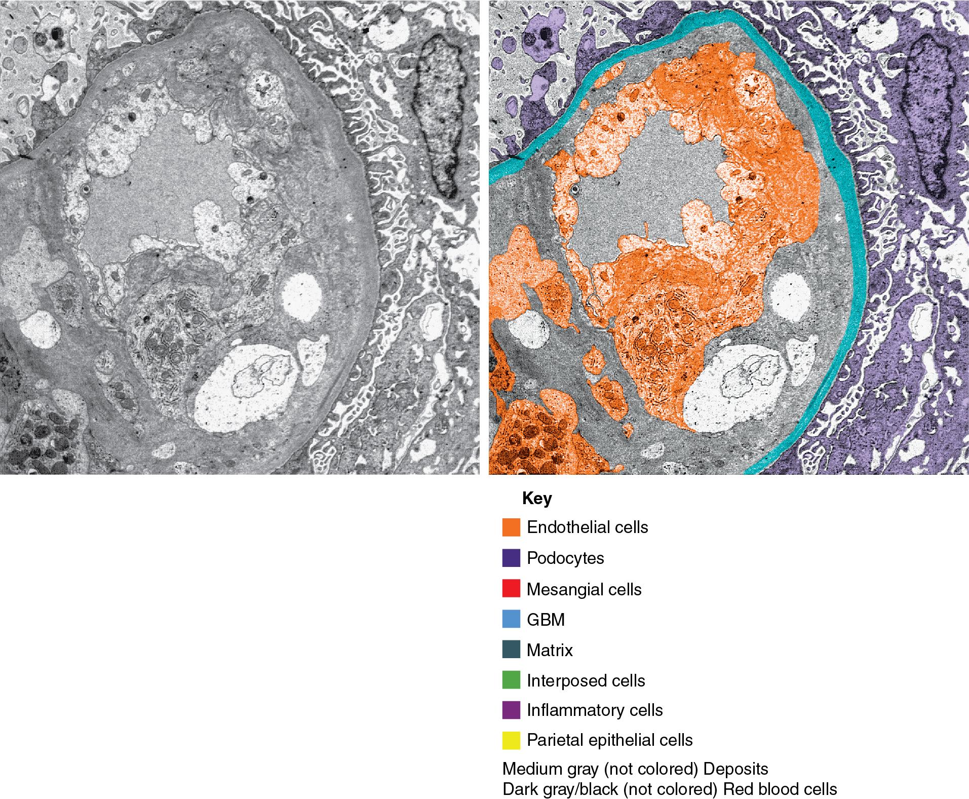 FIG. 8.5, Active antibody-mediated rejection. Transplant glomerulitis. By electron microscopy, there is endothelial cell swelling with separation of the endothelial cells from the basement membrane with the accumulation of a granular material in the subendothelial space. The term subendothelial electron-lucent widening is recommended by Banff for this lesion.