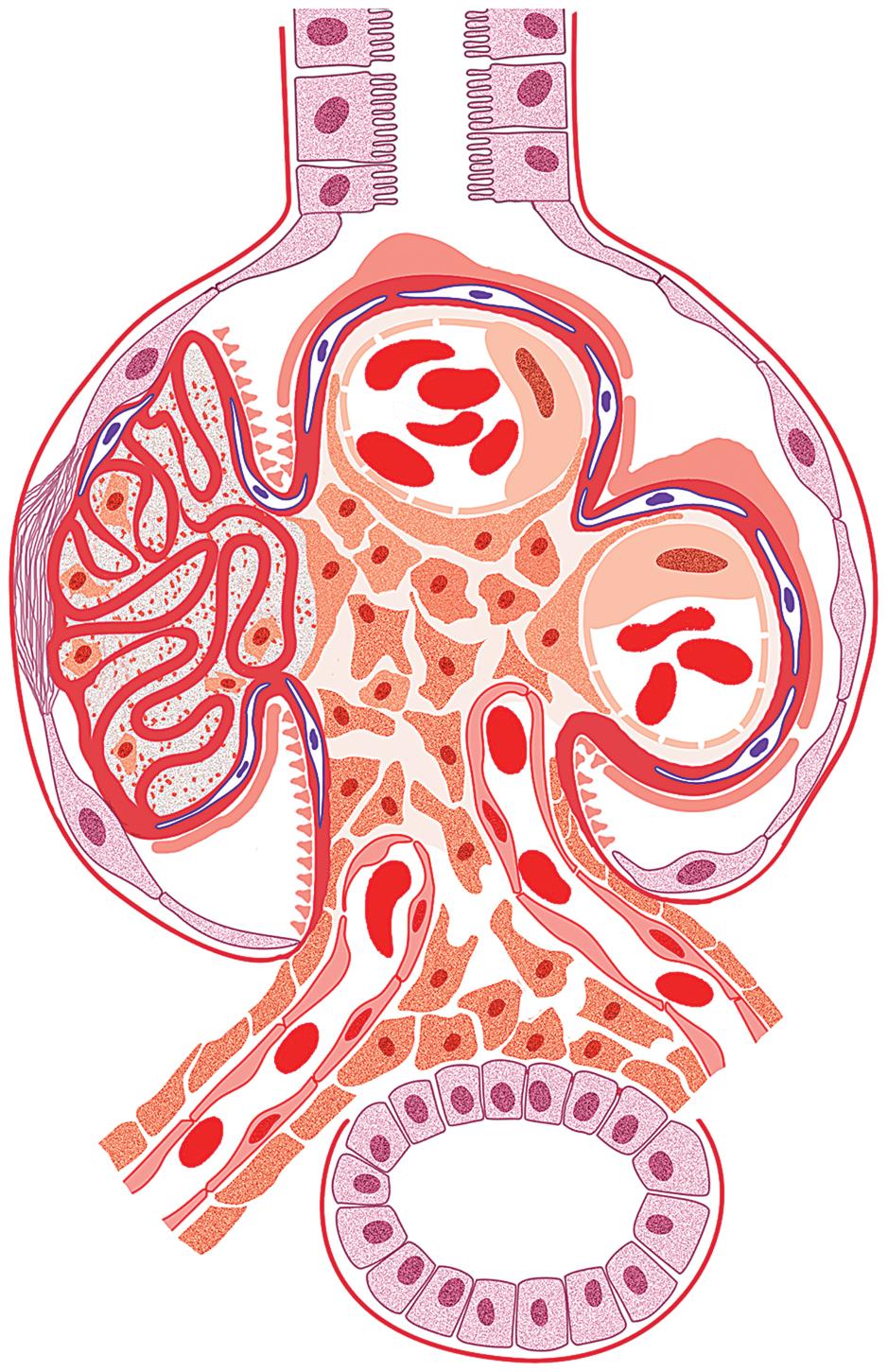 FIG. 8.6, Transplant glomerulopathy. There is segmental sclerosis and duplication of the glomerular basement membrane because of increased lamina rara interna without deposits.