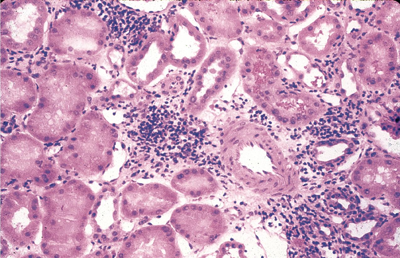 FIG. 8.7, Acute T cell–mediated rejection, Banff type borderline, suspicious for acute rejection. Changes suspicious for acute rejection are seen here as a minimal focal interstitial infiltrate with minimal evidence of tubulitis. Less than four lymphocytes are seen in a single tubule cross section in this image (hematoxylin and eosin, ×200).