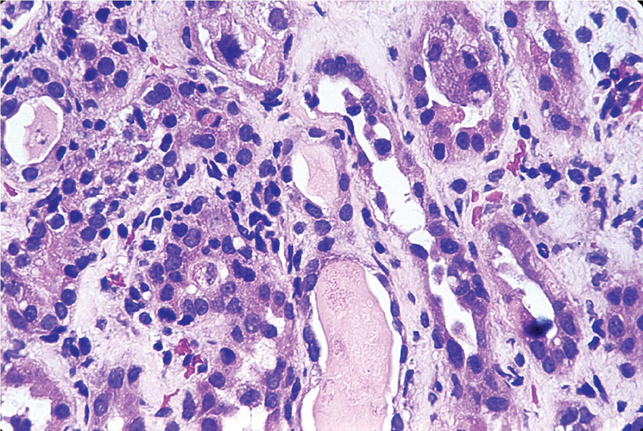 FIG. 8.8, Acute T cell–mediated rejection, Banff type IA. This category is defined by the presence of an interstitial infiltrate of lymphocytes with moderate tubulitis with greater than four mononuclear cells per tubular cross section. The interstitial infiltrate consists of lymphocytes and is patchy, involving less than 25% of the biopsy (hematoxylin and eosin, ×400).