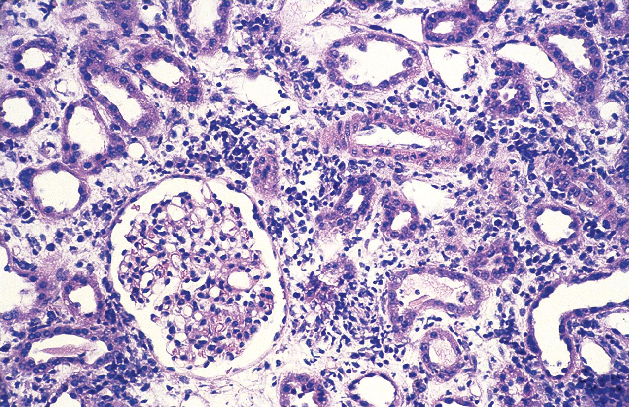 FIG. 8.9, Acute T cell–mediated rejection, Banff type IB. In this category, the interstitial infiltrate is more extensive, involving greater than 25% of the biopsy with numerous foci of severe tubulitis with greater than 10 mononuclear cells per tubular cross section. The vessels show no evidence of involvement (hematoxylin and eosin, ×200).