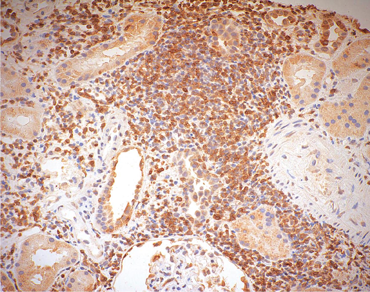 FIG. 8.10, Acute T cell–mediated rejection. The interstitial infiltrate consists of a mixed population of T cells. The large population of T cells is identifiable by the presence of the CD3 antigen, here shown by immunohistochemistry (anti-CD3 immunostaining, ×200).