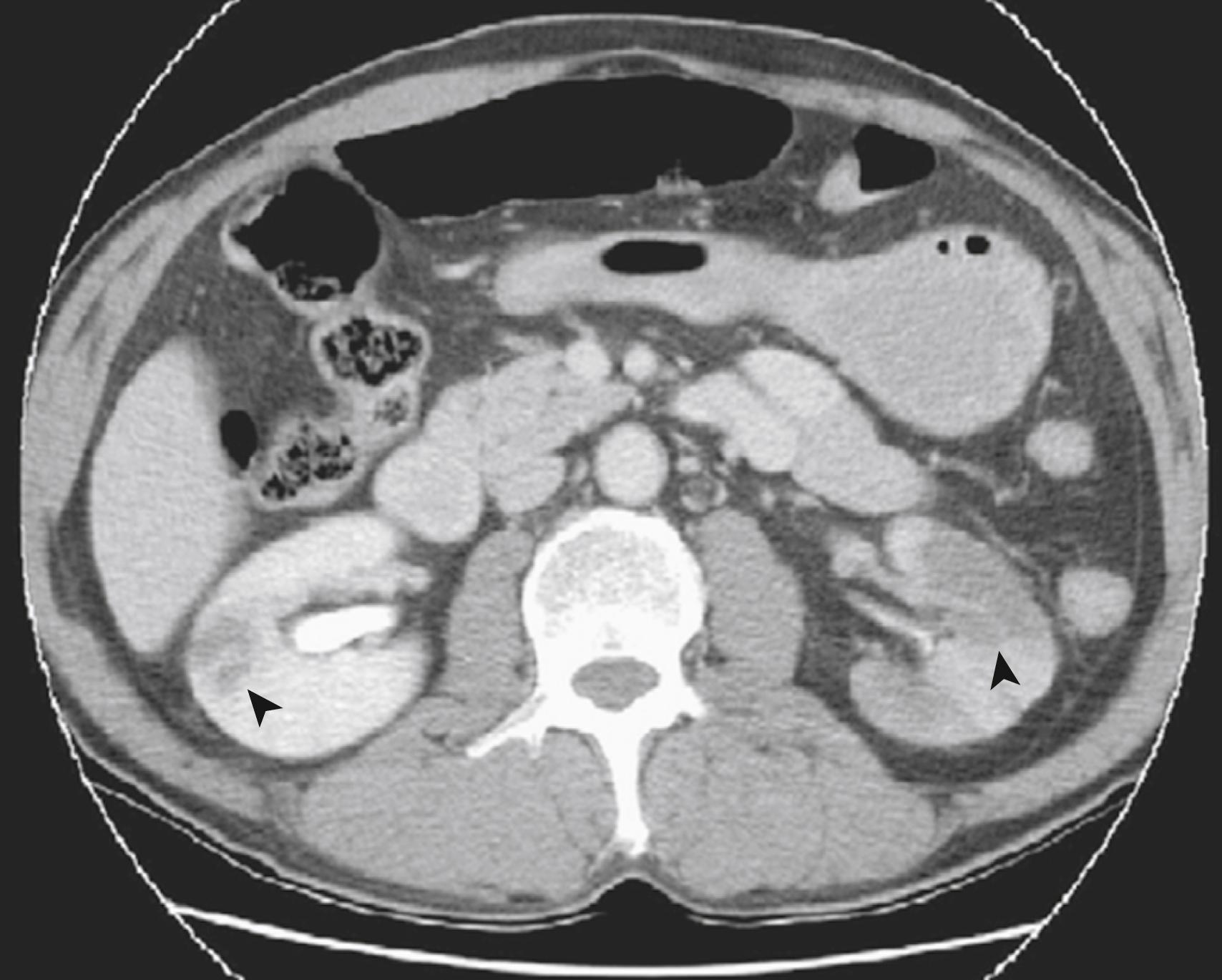 Figure 130.3, Computed Tomography Angiography Demonstrating Bilateral Renal Infarcts.