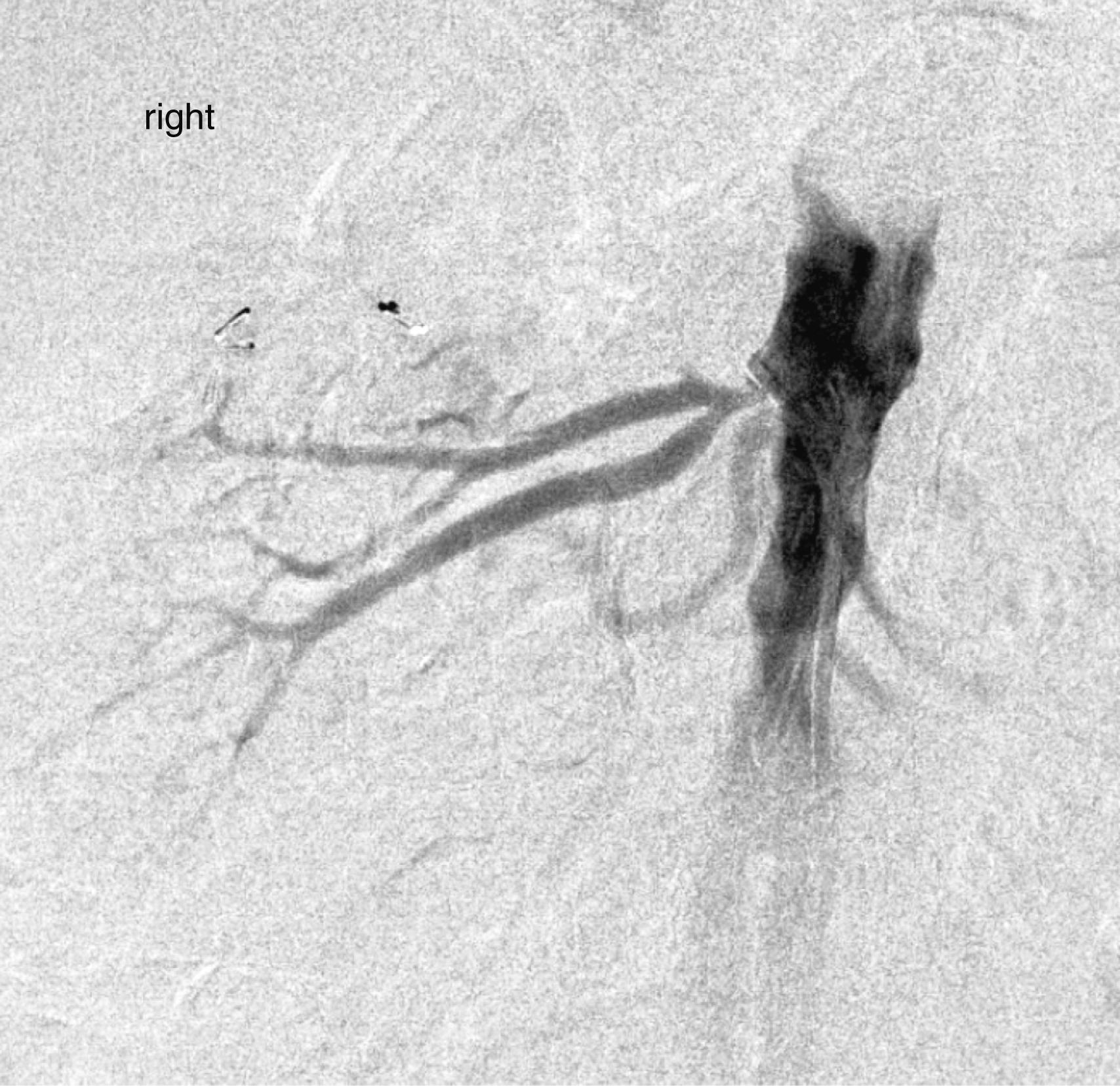 Figure 129.1, Arteriogram demonstrating early bifurcation of the right main renal artery.