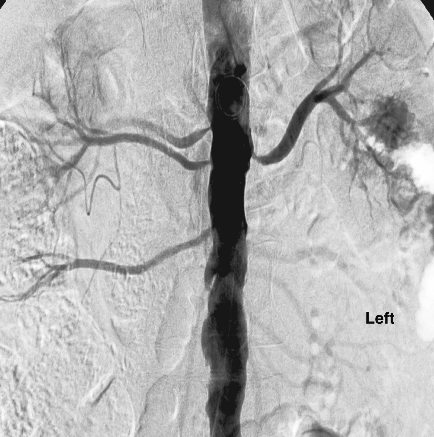 Figure 129.2, Abdominal aortogram demonstrates hemodynamically significant stenosis involving multiple renal arteries.
