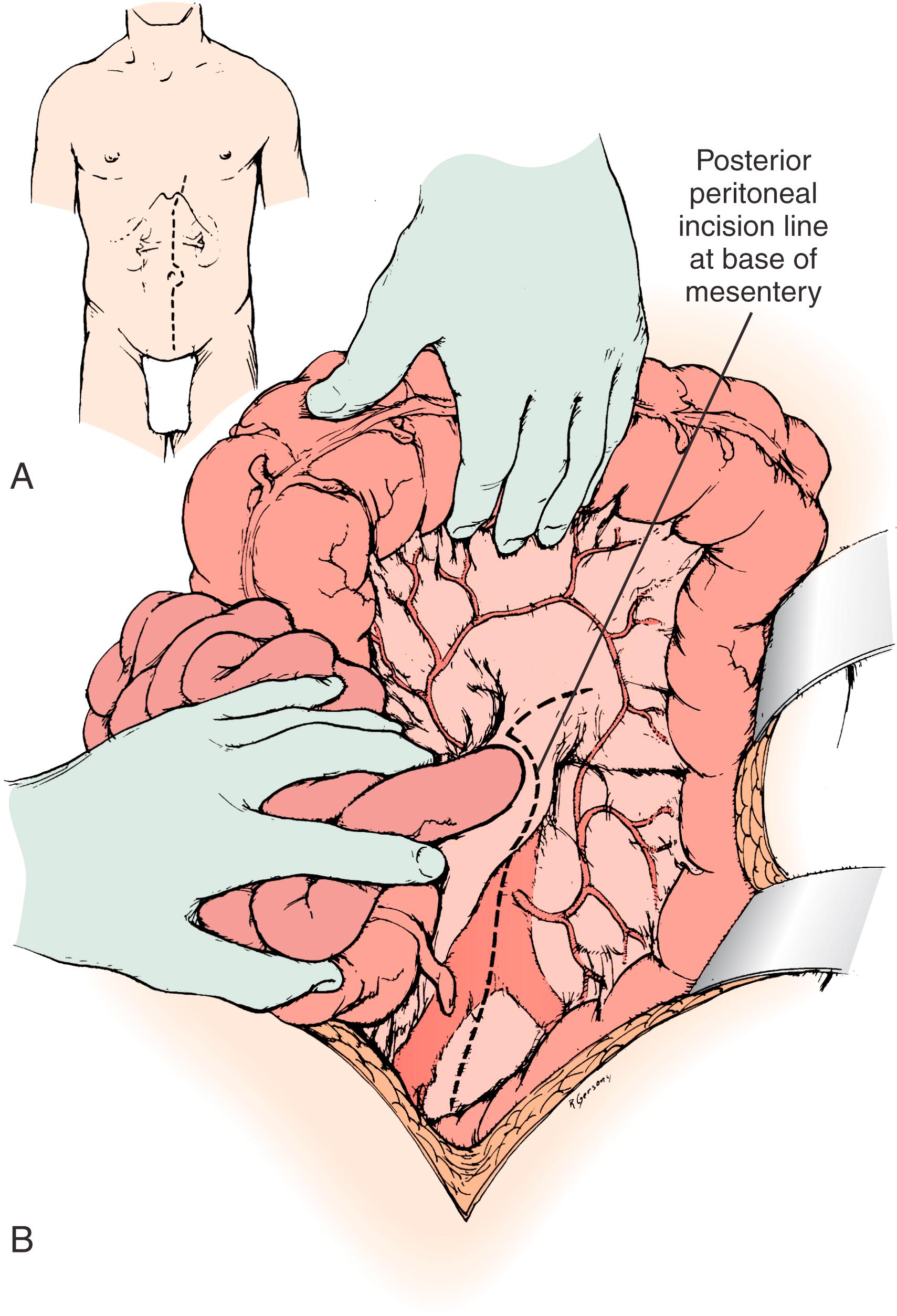 Figure 128.2, ( A and B ) Exposure of the aorta and left renal hilum through the base of the mesentery. Extension of the posterior peritoneal incision to the left, along the inferior border of the pancreas, provides entry to an avascular plane posterior to the pancreas. This allows excellent exposure of the entire left renal vein and hilum as well as of the proximal right renal artery.
