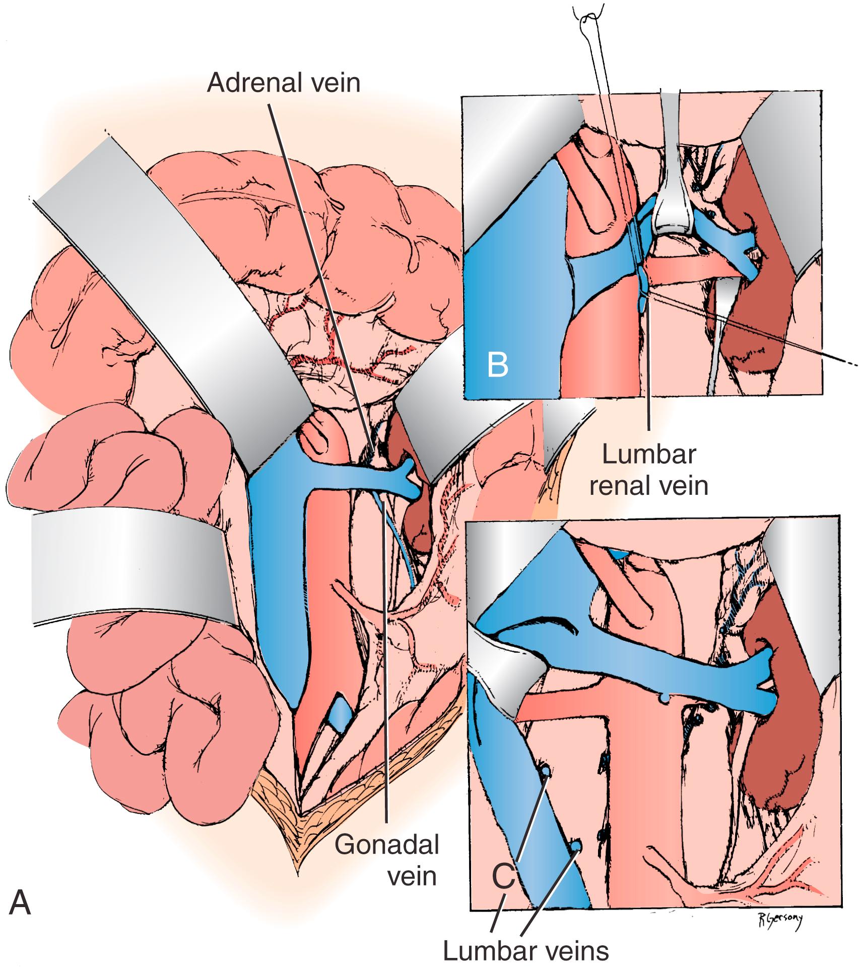 Figure 128.3, ( A ) Exposure of the proximal right renal artery through the base of the mesentery. ( B ) Mobilization of the left renal vein by ligation and division of the adrenal, gonadal, and lumbar-renal veins allows exposure of the entire left renal artery to the hilum. ( C ) On occasion, lumbar veins are ligated and divided to allow retraction of the vena cava to the right. Often, adequate exposure of disease of the proximal renal artery can be obtained without this maneuver.