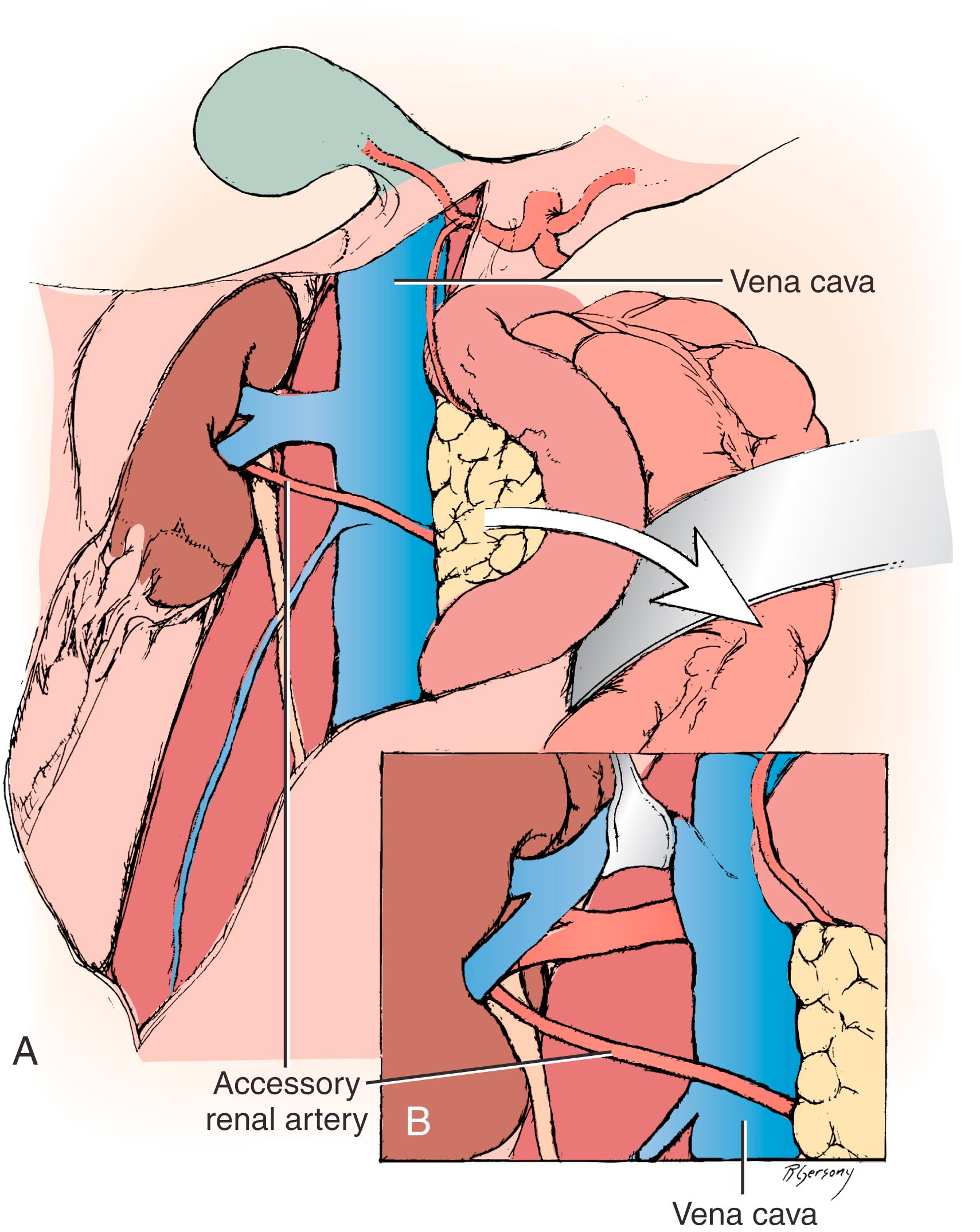 Figure 128.4, ( A ) Arteries encountered anterior to the vena cava should be considered accessory renal arteries and preserved. ( B ) The right renal vein is typically mobilized superiorly for exposure of the distal right renal artery.