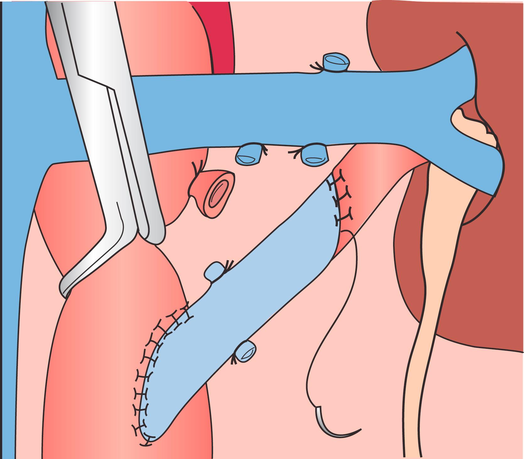 Figure 128.5, Technique for end-to-end aortorenal bypass grafting. The length of arteriotomy is at least three times the diameter of the artery so as to prevent recurrent anastomotic stenosis. For the anastomosis, 6-0 or 7-0 monofilament polypropylene sutures are used in continuous fashion with loupe magnification. If the apex sutures are placed too deeply or with excess advancement, stenosis can be created, posing a risk of late graft thrombosis.