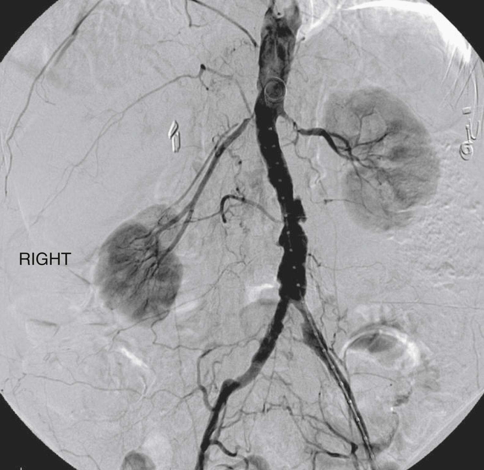 Figure 127.1, Digital subtraction angiogram illustrating bilateral atherosclerotic renal artery stenosis.