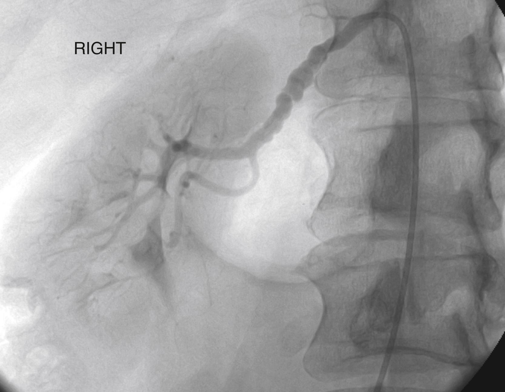 Figure 127.3, Angiogram demonstrating “string of beads” appearance in renal fibromuscular dysplasia.