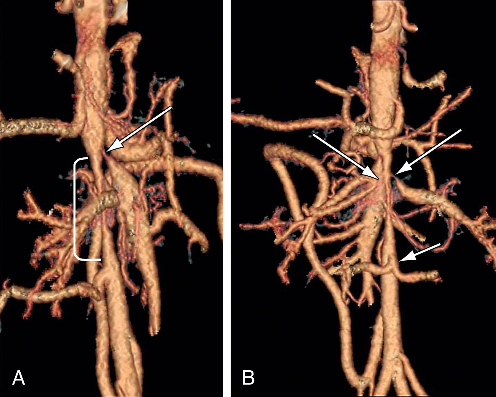 Figure 132.1, ( A ) Suprarenal abdominal aortic coarctation (bracket) with superior mesenteric artery stenosis (arrow) . ( B ) Bilateral renal artery stenoses (arrows) . Note common trunk of lower lumbar artery (arrow) on posterior projection.