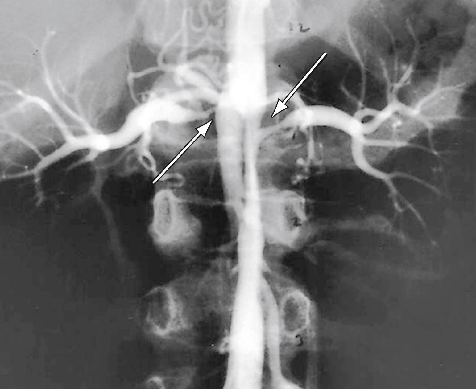 Figure 132.2, Intrarenal abdominal aortic coarctation with bilateral artery stenosis (arrows) .