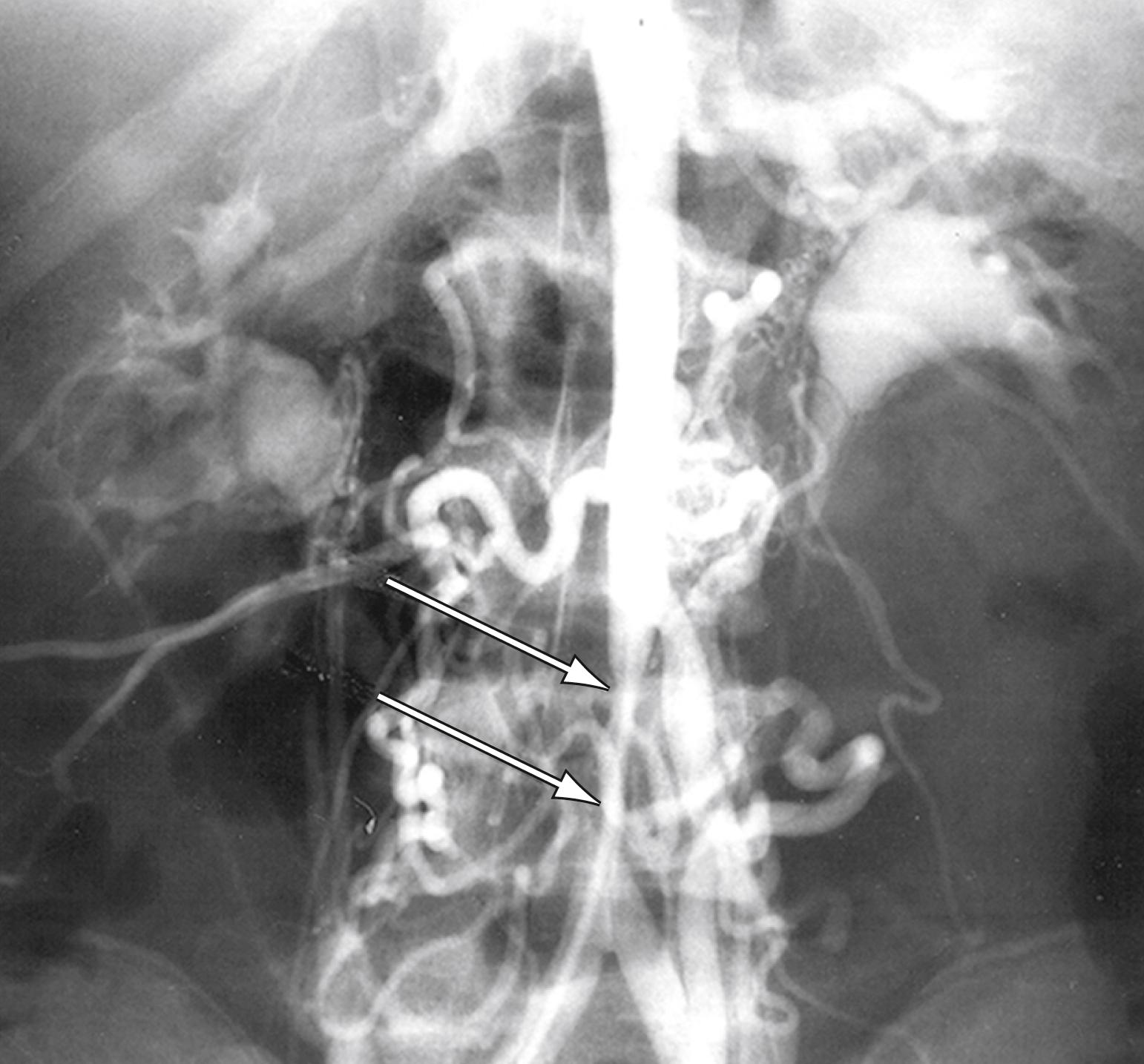 Figure 132.3, Infrarenal abdominal aortic coarctation manifest by tubular stenosis extending from a dilated inferior mesenteric artery to the aortic bifurcation ( arrows ).