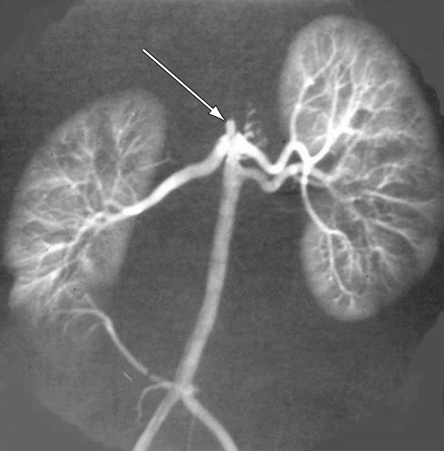 Figure 132.4, Multiple bilateral renal arteries in a patient with a near-occlusive coarctation of the suprarenal aorta (arrow) .