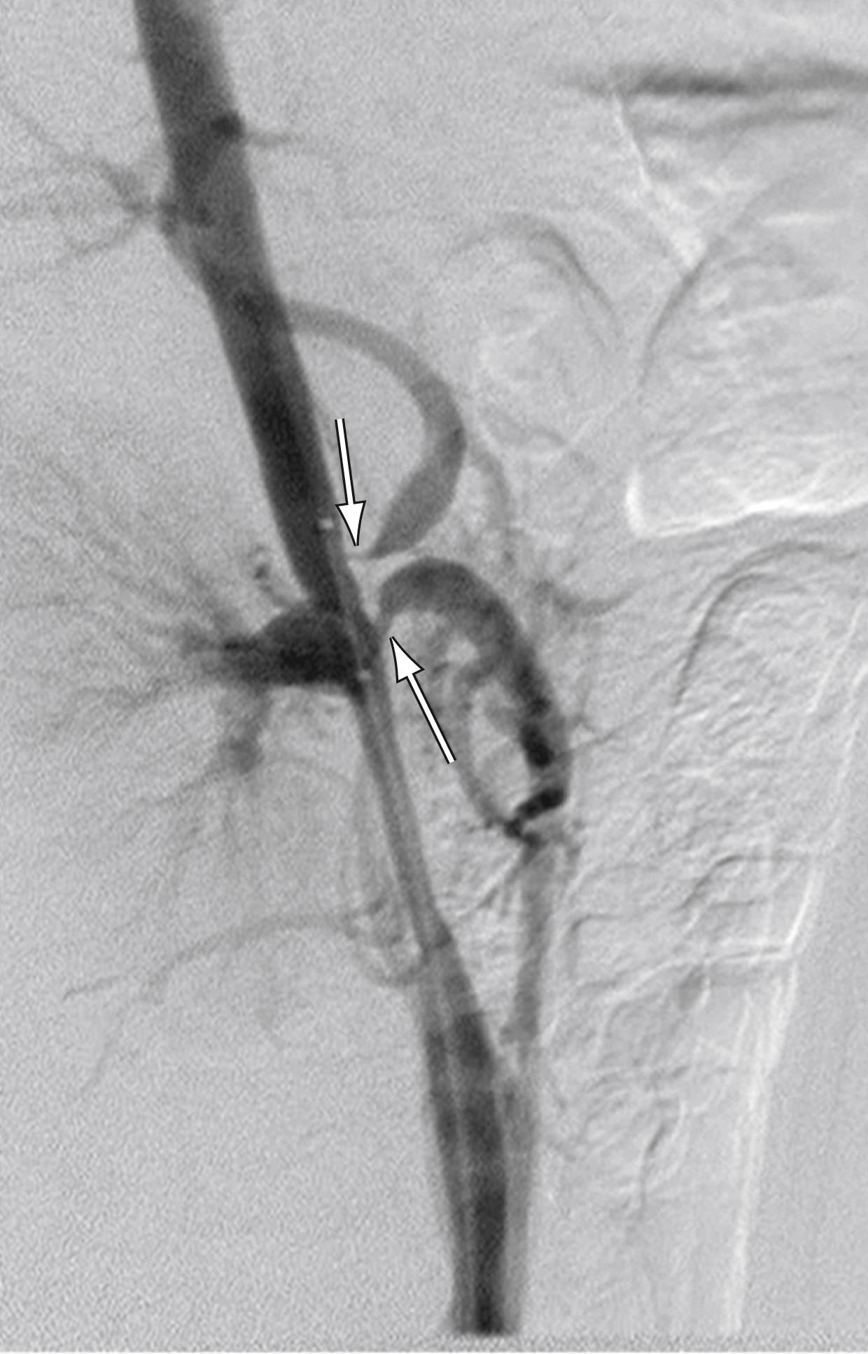 Figure 132.6, Severe celiac artery and superior mesenteric artery ostial stenoses evident on a lateral aortogram (arrows) .