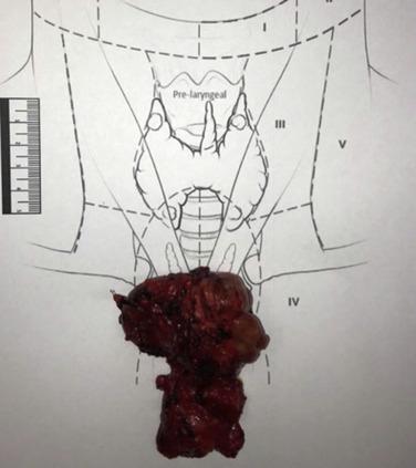 Fig. 9.1, Recurrent benign mediastinal goiter presenting several years after total thyroidectomy.