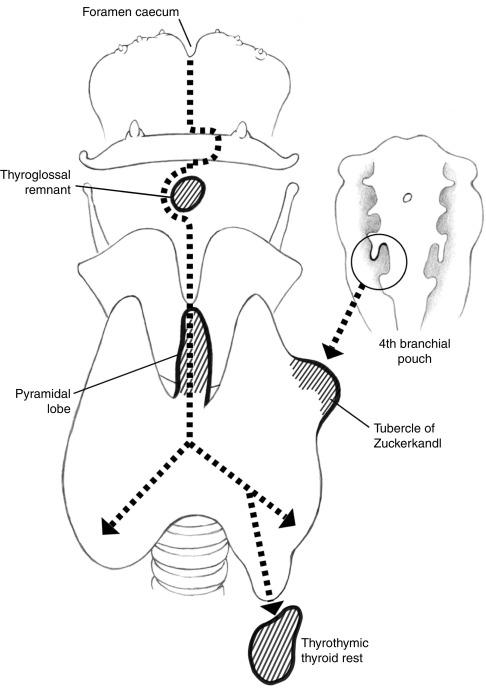 Fig. 9.3, Embryology of thyroid descent, demonstrating the origin of the three common sites of recurrence in embryologic remnants, namely the pyramid, thyrothymic remnants, and posterior elements of the tubercle of Zuckerkandl.