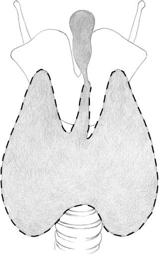 Fig. 9.4, Common Site of Pyramidal Recurrence Lying in the Notch of the Thyroid Cartilage.