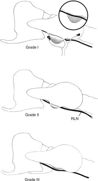 Fig 9.6, Recurrence in the posterior element of the tubercle of Zuckerkandl, which may lie behind the esophagus or between trachea and esophagus.