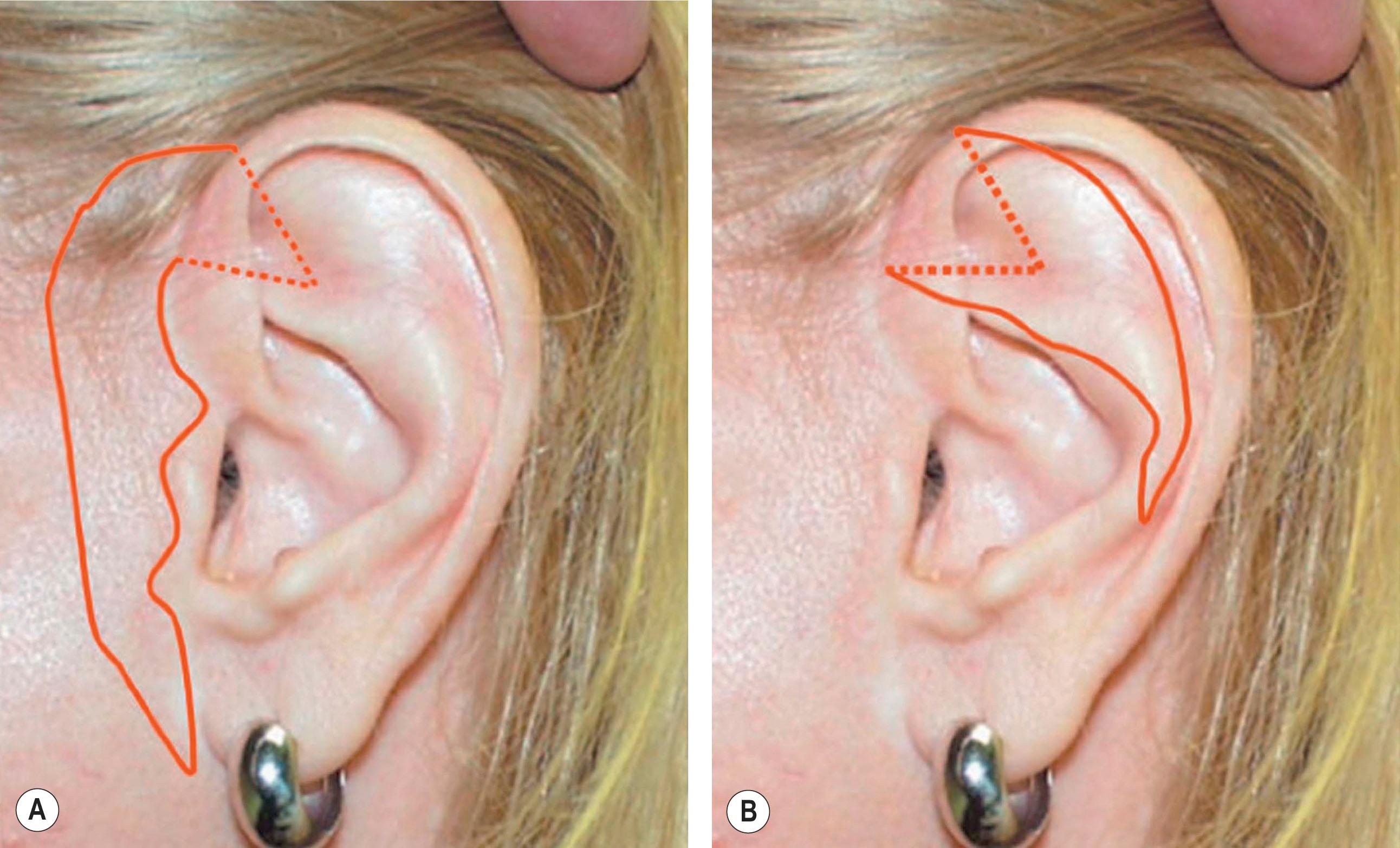 Figure 19.11, Occasionally, an extended skin graft is needed in addition to the composite graft for reconstruction of nasal defects. (A) The solid lines indicate skin incisions and the dotted line indicates a cartilaginous incision. (B) The solid lines represent the harvest of a postauricular full-thickness skin graft.