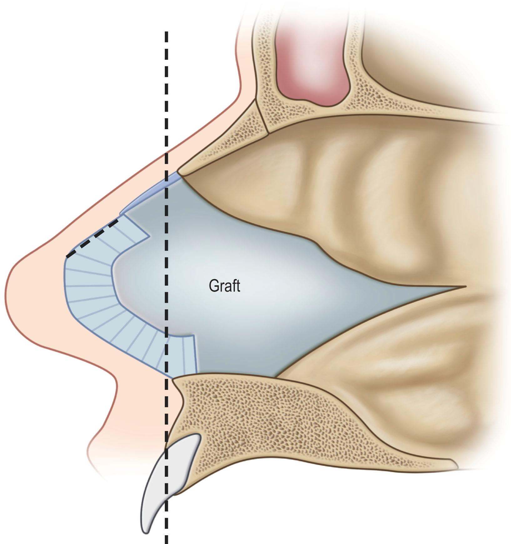 Figure 19.13, Harvest of nasal septal cartilage graft. It is important to keep the L-shaped strut cartilage (striped area) to provide nasal support. The area of septum that attaches to the upper lateral cartilages should also be preserved. Generally, nonsupportive quadrangular cartilage, which is pictured posterior to the dashed vertical line, can be harvested freely.
