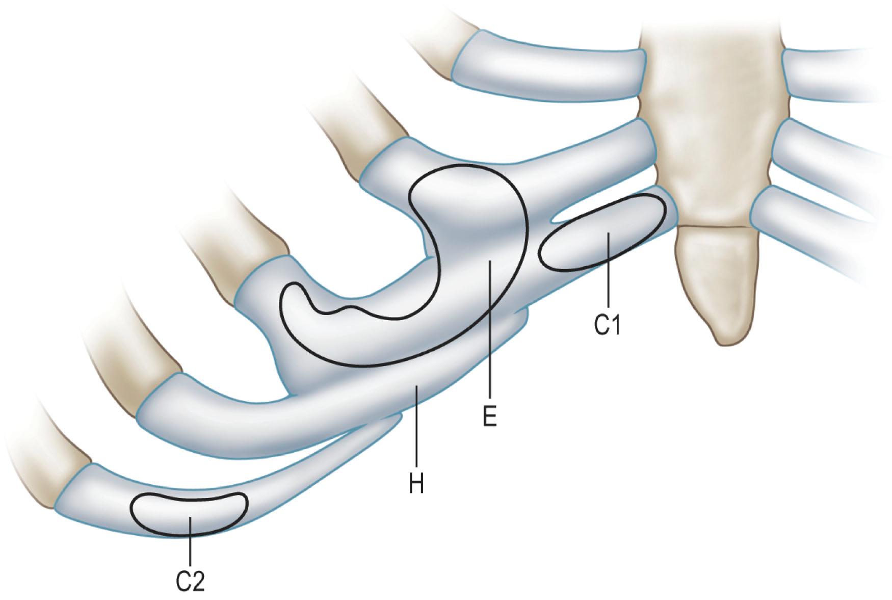 Figure 19.15, Donor site for costal cartilage grafts in auricular framework and chin graft construction. E, Ear base block; H, helix; C1, chin graft, first layer; C2, chin graft, second layer.