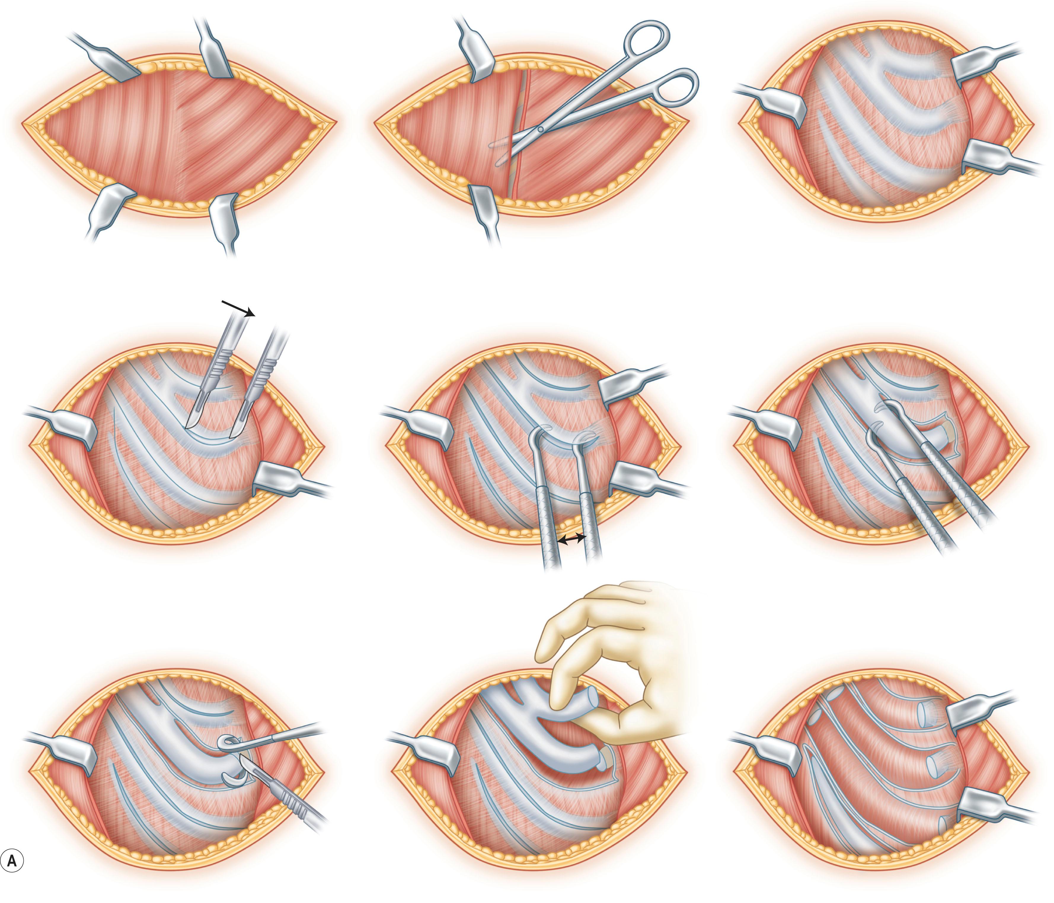 Figure 19.16, (A) Schematic illustration of the new method of costal cartilage harvest. (Top, left) The muscular fascia of the rectus abdominis muscle and the external oblique muscle are exposed. (Top, center) A longitudinal incision is made between the rectus abdominis muscle and the external oblique muscle with delicate dissecting scissors. (Top, right) The perichondrium is completely exposed. (Center, left) The line of incision is marked in the center of the costal cartilage, and, taking special care not to injure or damage the cartilage, the incision is made with a scalpel. (Center, center) The anterior surface of the perichondrium is first undermined with an elevator. (Center, right) The undermining of the posterior surface of the perichondrium requires extreme caution because the risk of pneumothorax exists; therefore, the tip of the elevator is placed on the cartilage or must face the cartilage to avoid accidental puncture of the thoracic wall. The approximately 1 cm of periosteum at the costochondral junction is undermined for easier harvest of the costal cartilage. (Bottom, left) A Doyen rib raspatory is inserted underneath the undermined costal cartilage between the cartilage and the perichondrium at the costochondral junction. The costal cartilage is excised with a scalpel and the costochondral junction is to be left behind at the donor site. (Bottom, center) Harvesting of the costal cartilages is easier if the sixth and seventh costal cartilages are harvested from the side of the costochondral junction instead of the sternal side. (Bottom, right) The appearance of the donor site immediately after the harvest of the costal cartilages. The perichondrium is left completely intact at the donor site. (B) (Top, left) The perichondrium is sutured with 4-0 nylon at 5 mm intervals with the exception of one area for the return of the remaining costal cartilage after fabrication of the three-dimensional costal cartilage framework, which is cut into 2–3 mm blocks. A small funnel is placed in the unsutured opening of the perichondrium for returning the cut cartilage blocks. (Top, center) The appearance after the return of cut cartilage blocks. The cartilage blocks are visible at the opening of the perichondrium. (Top, right) Intercostal nerve block is performed for reducing postoperative pain with 0.25% bupivacaine under direct vision. A total of 5 mL is administered per rib. (Bottom) The muscle and muscular fascia are sutured with 4-0 nylon and a Penrose drain is placed under the muscular layer.