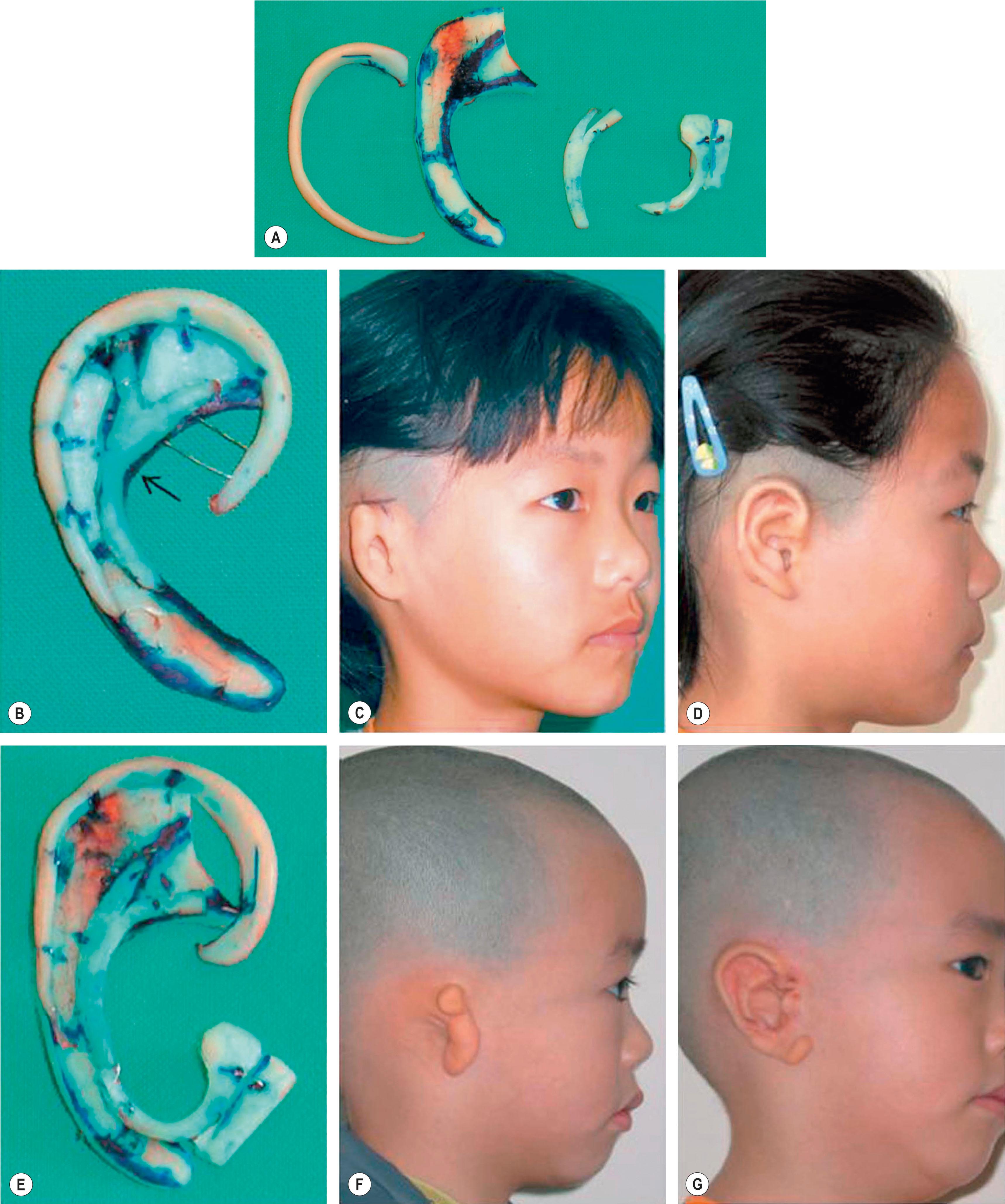 Figure 19.17, (A) The modified rib cartilage framework may contain these parts to provide prominent structures. From left to right, the helix, the base frame, the Y-shaped antihelical complex, and the tragus attached with an additional cartilaginous cube. (B-G) Auricular reconstruction with modified frameworks. (B–D) A 7-year-old girl presented with congenital microtia. (B) The three-dimensional framework used: the arrow indicates the Y-shaped antihelical complex attached on the base frame. (C) Preoperative oblique view of conchal-type microtia. (D) Close-up appearance of the reconstructed auricle 8 months after grafting of the framework. (E–G) A 6-year-old boy presented with congenital microtia. (E) The completed costal framework with Y-shaped antihelical complex and the tragus attached to an additional cartilaginous cube. (F) Preoperative lateral view of sausage-type microtia. (G) Postoperative oblique view, 3 months after grafting of the framework.