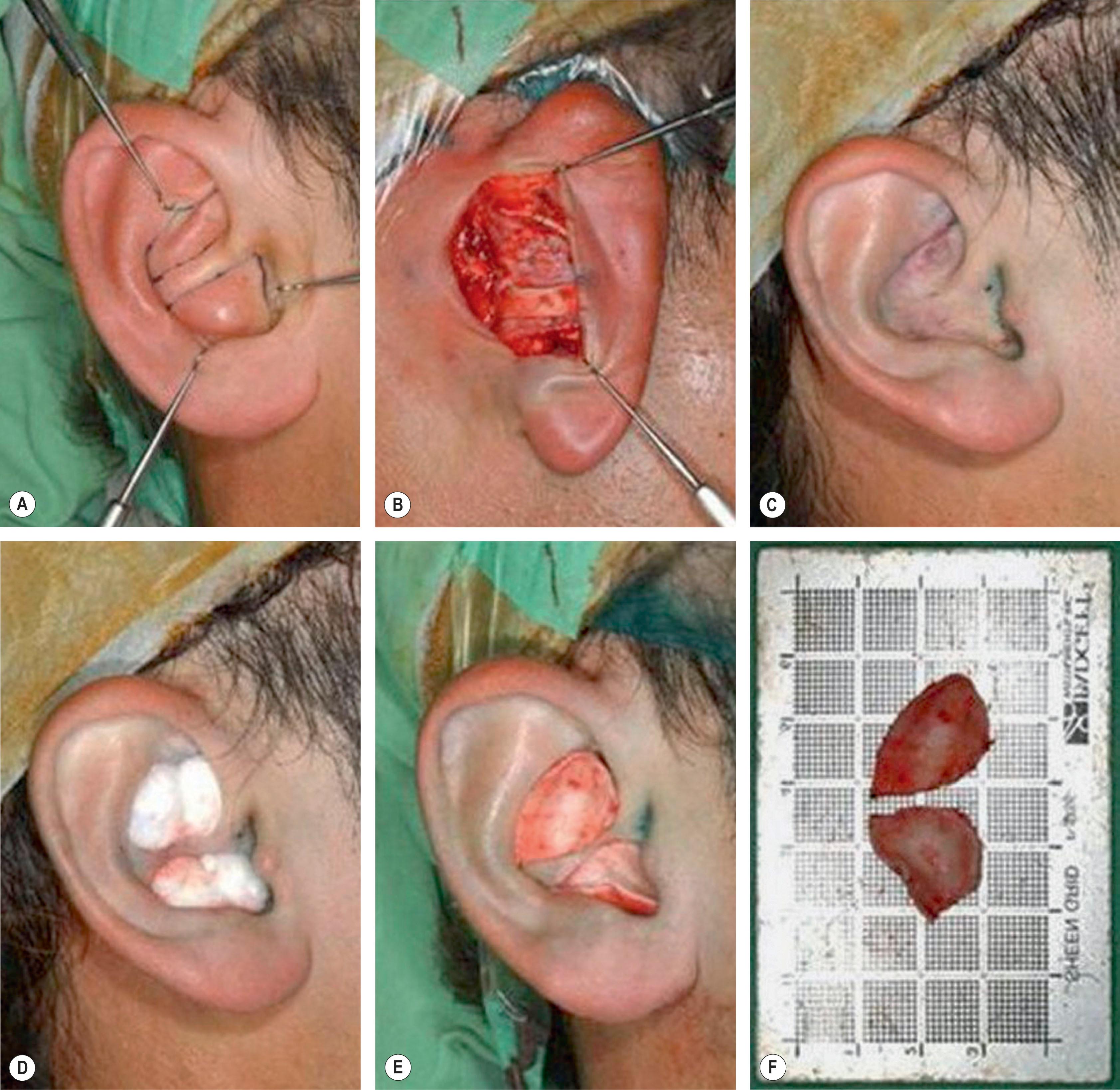 Figure 19.2, The surgical technique for harvesting the maximal amount of conchal cartilage graft. (A) Markings. It was necessary to leave at least 2 mm of the superior outer rim along the conchal wall, in order not to cause a noticeable change in the conchal bowl of the donor ear. Note the helical crus with its lateral extension between the cymba concha and cavum concha. (B) The entire unit of the cymba concha and cavum concha was removed separately, which left at least 5 mm of the crus helicis with an extension to prevent collapsing. (C) There is almost no external evidence that the large conchal cartilage graft had been removed. (D) Two peanut cotton balls were placed into the interstices of the ear and sutured in place with through-and-through 4-0 nylon sutures, which were removed 5 days later. (E) The harvested cymba and cavum conchae were placed in situ to demonstrate their relationship with the intact helical crus and its lateral extension. (F) The surface area was 224.0 mm 2 at the cymba concha and 247.0 mm 2 at the cavum concha.