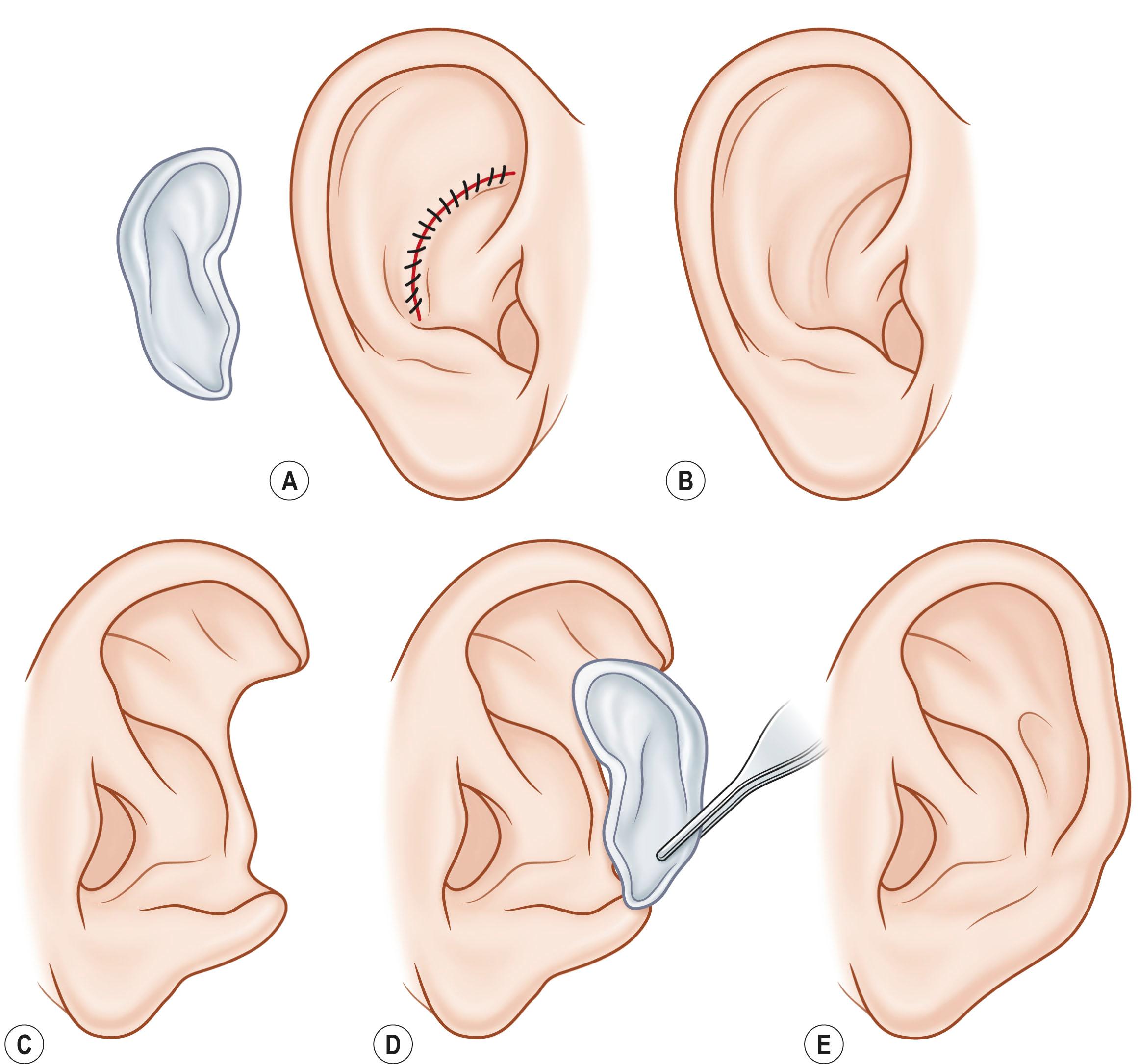 Figure 19.3, Repair of partial ear deformity with autogenous conchal cartilage graft. (A) Donor conchal cartilage is excised through an “anteromedial approach”. (B) Healed donor ear. Note the almost imperceptible scar. (C) Middle-third postsurgical auricular defect. (D) Conchal cartilage graft from the contralateral ear. (E) Result obtained by the “tunnel procedure” of Converse. Secondary procedures will be necessary to release the ear and improve helical contour.