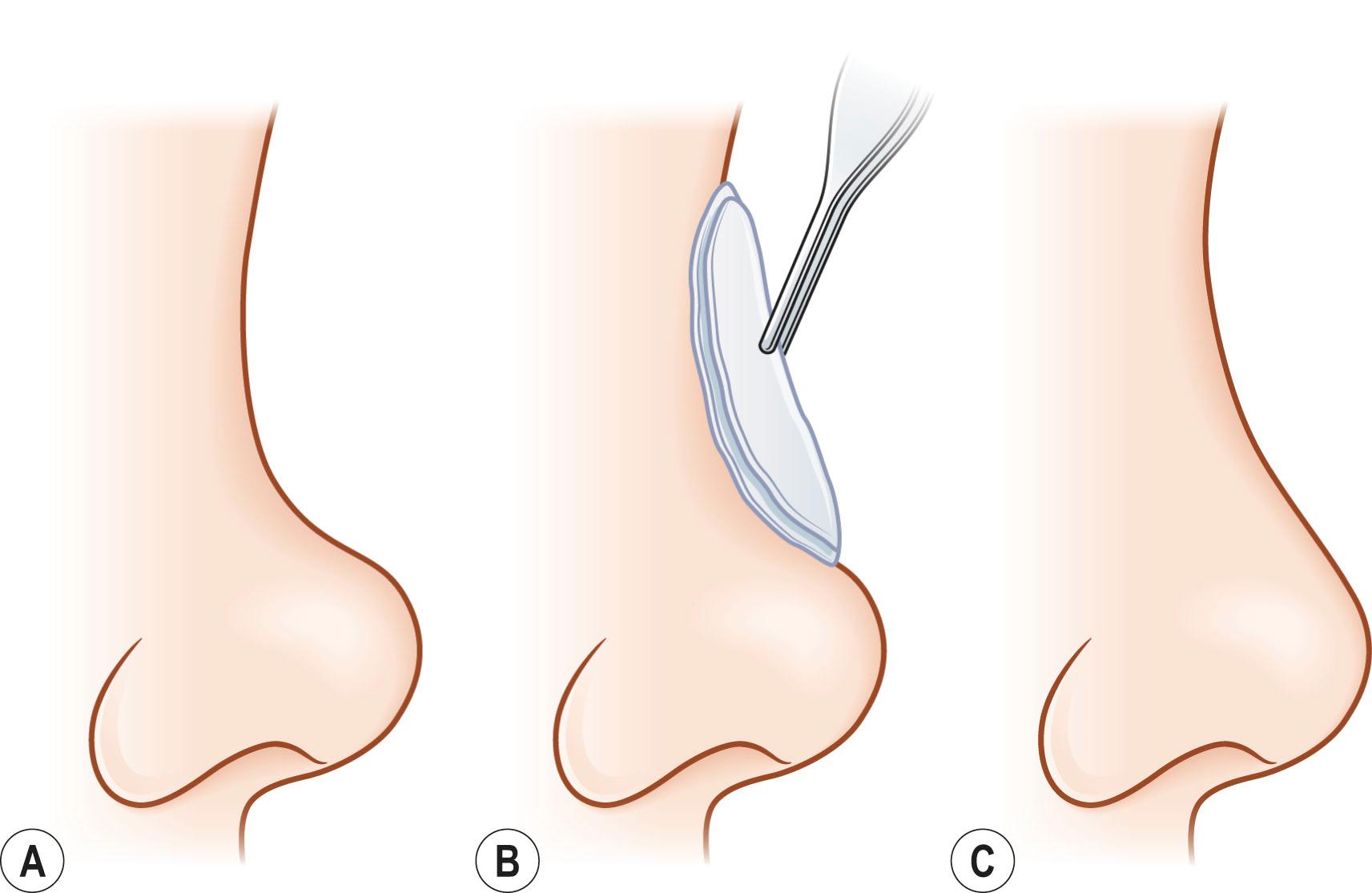 Figure 19.4, Auricular cartilage employed as a laminated contour graft. (A) Post-traumatic saddle nose deformity. A previous submucous resection eliminated the septum as a possible cartilage graft source. (B) A laminated auricular cartilage graft was fabricated from a bilateral conchal cartilage excision. ( C) Final result.